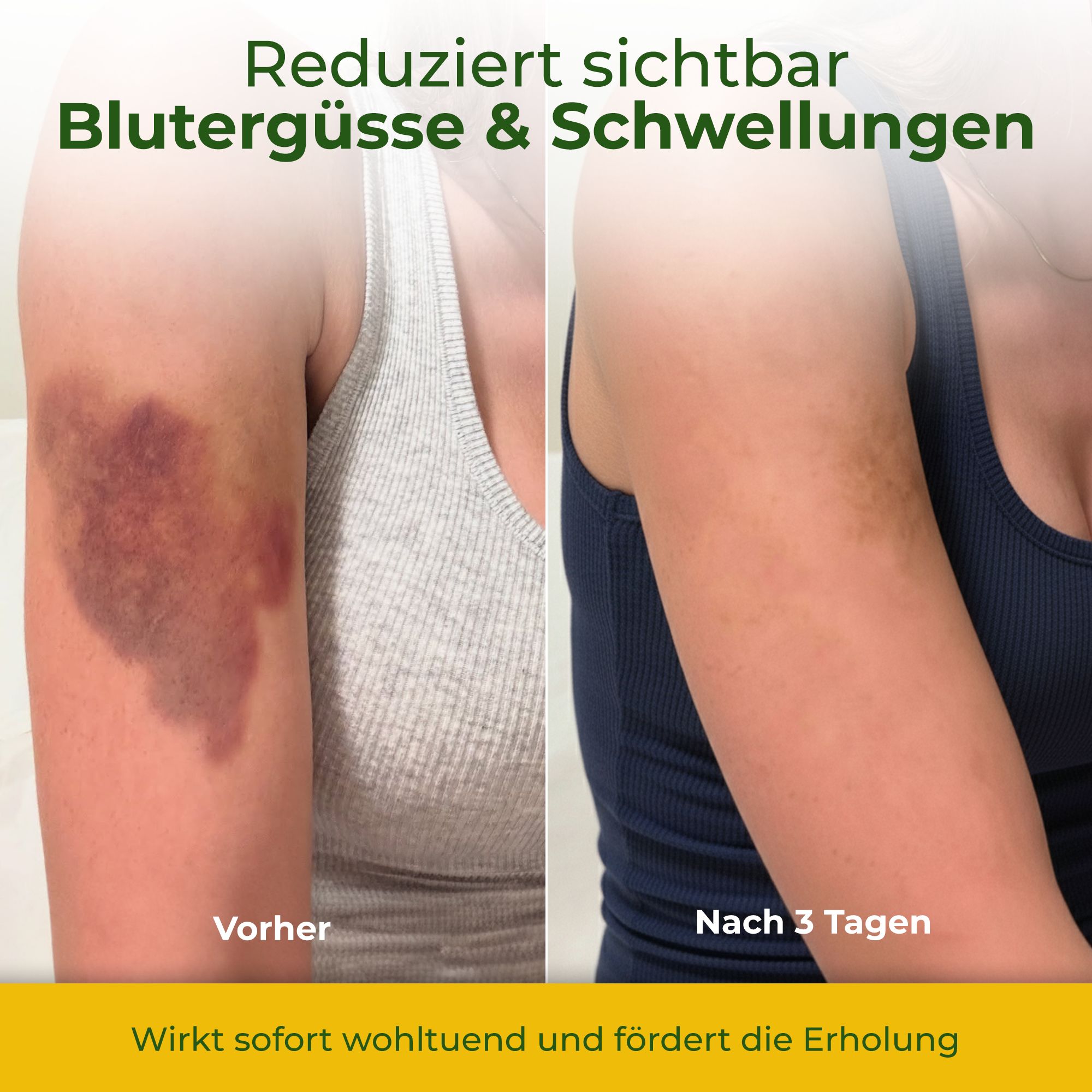 Vorher-Nachher-Vergleich. Arm mit großem blauen Fleck, dann nach 3 Tagen weniger. Text: Reduziert Blutergüsse & Schwellungen.