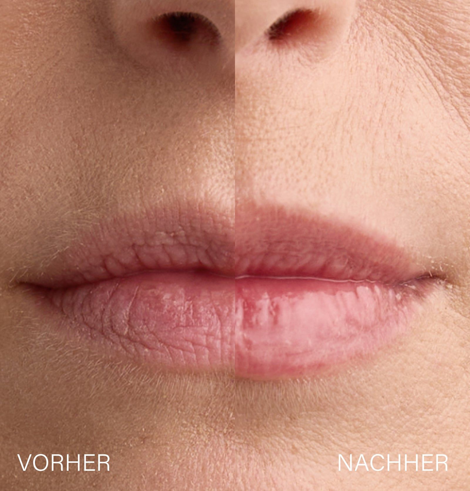 Nahaufnahme von Lippen. Links: Vorher. Rechts: Nachher. Lippen sind voller und rosiger.