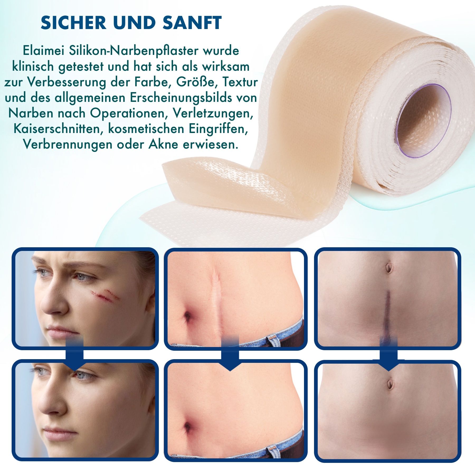 Rolle Silikonpflaster, beige. Anwendung bei Narben nach Operationen, Verletzungen, Kaiserschnitten, Verbrennungen.