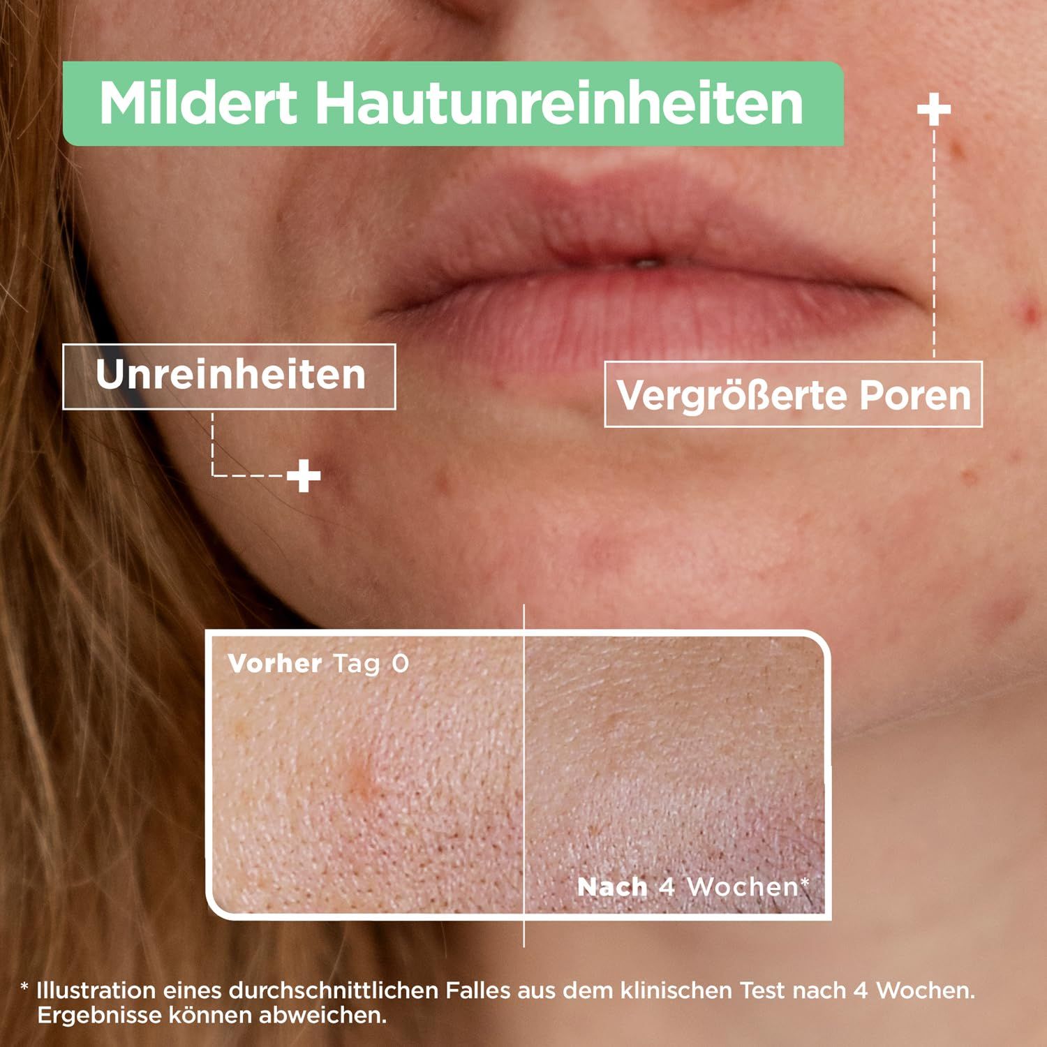 Nahaufnahme von Hautunreinheiten und vergrößerten Poren. Vergleich Vorher/Nachher nach 4 Wochen. Text: Mildert Hautunreinheiten.