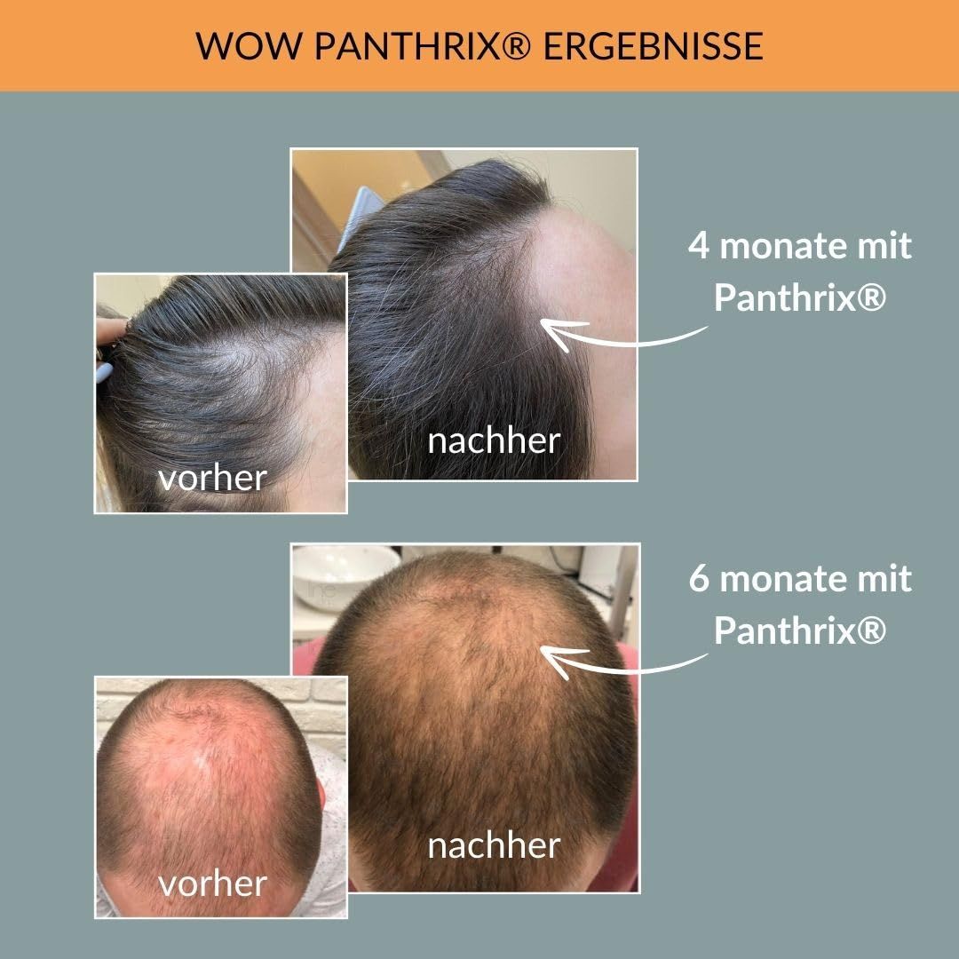 Vorher-Nachher-Bilder von Kopfhaut. Text: 4 Monate mit Panthrix, 6 Monate mit Panthrix. Ergebnisse.