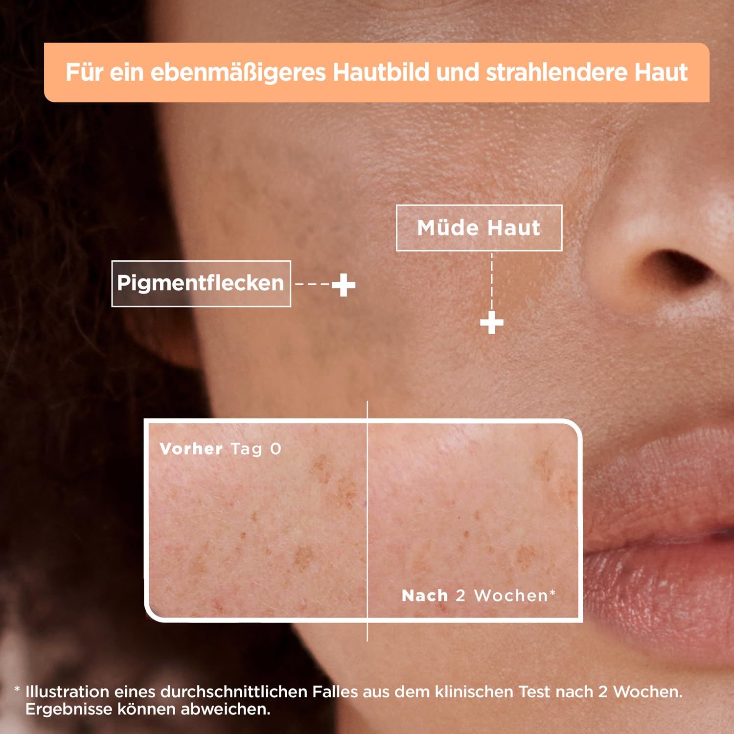 Nahaufnahme von Haut mit Pigmentflecken. Vergleich: Vorher (Tag 0) und Nachher (2 Wochen). Text: Für ein ebenmäßigeres Hautbild.