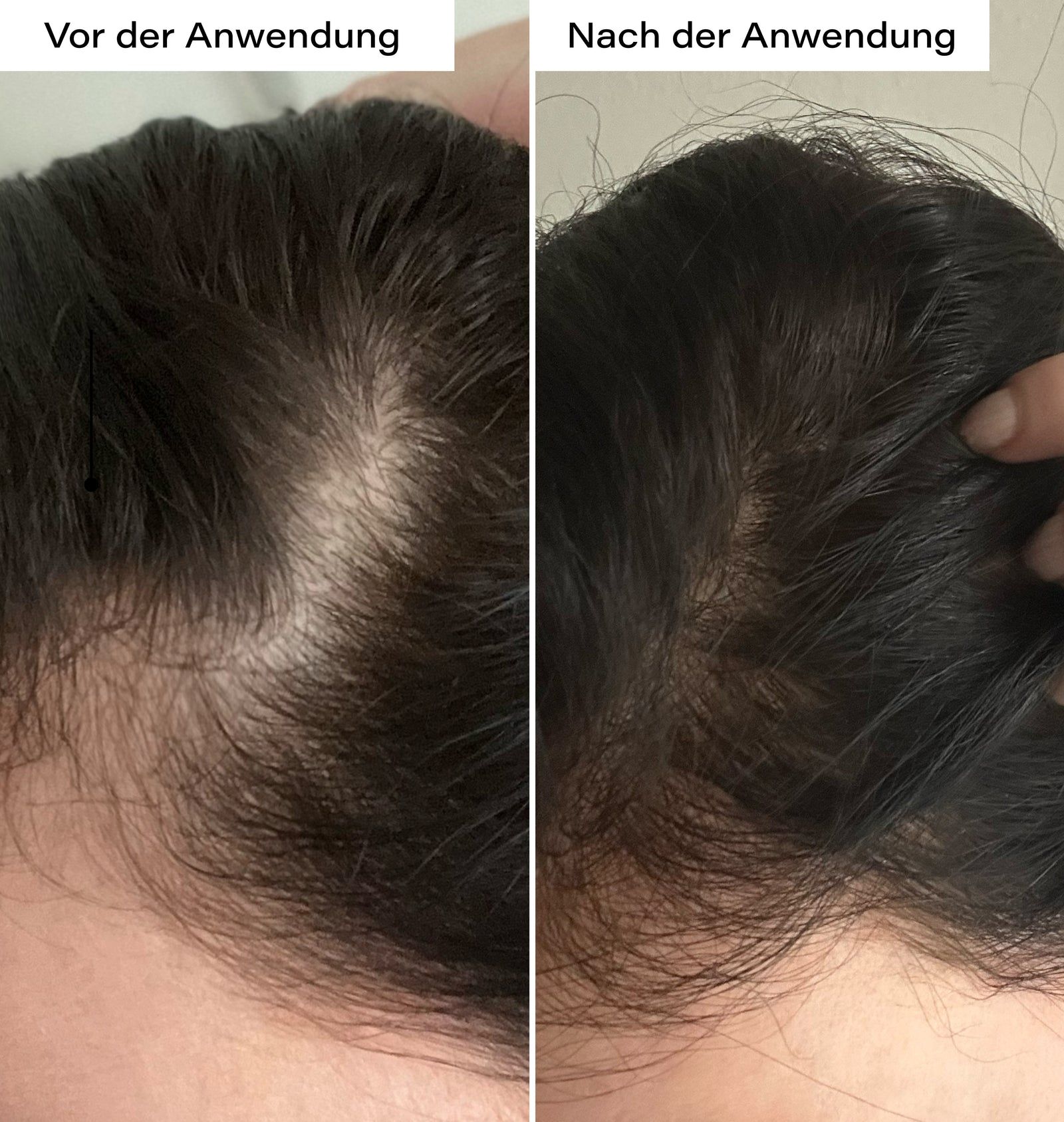 Zwei Nahaufnahmen von Kopfhautbereichen. Links: Vor der Anwendung. Rechts: Nach der Anwendung. Haare sichtbar.