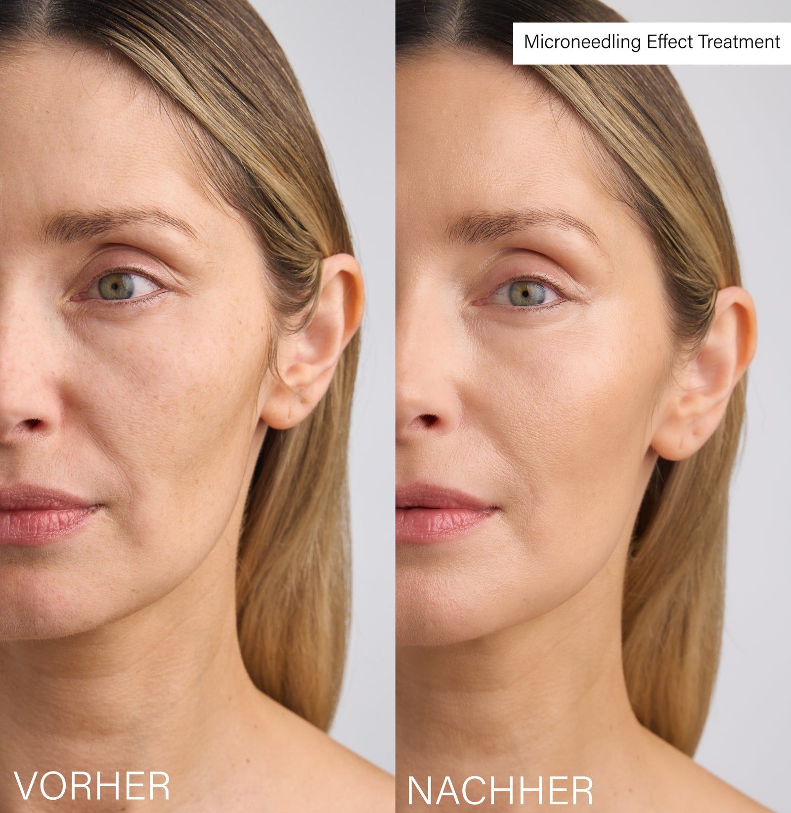 Vorher-Nachher-Vergleich eines Gesichts. Links: Vorher. Rechts: Nachher. Text: Microneedling Effect Treatment.