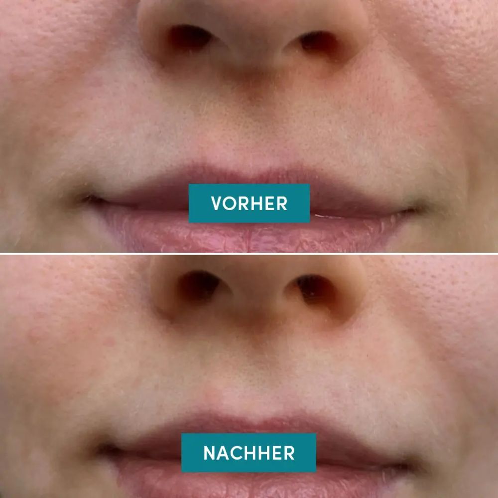 Vorher-Nachher-Vergleich von Lippen. Obere Reihe: Vorher. Untere Reihe: Nachher. Text: Mundfalten Pads.