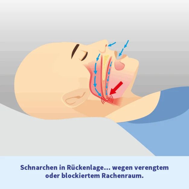 Illustration: Mann im Profil, Schnarchen in Rückenlage. Roter Pfeil zeigt verengten Rachenraum. Text: Schnarchen in Rückenlage...
