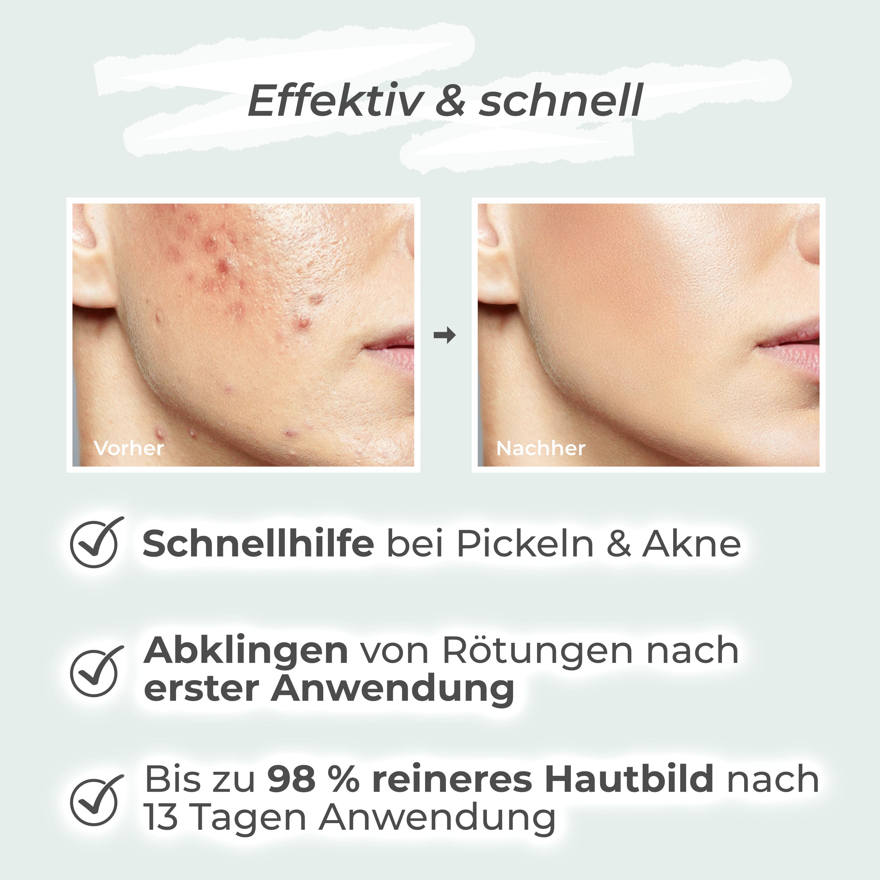 Vorher-Nachher-Vergleich von Haut. Text: Schnellhilfe bei Pickeln & Akne, Rötungsreduktion, bis zu 98% reineres Hautbild.