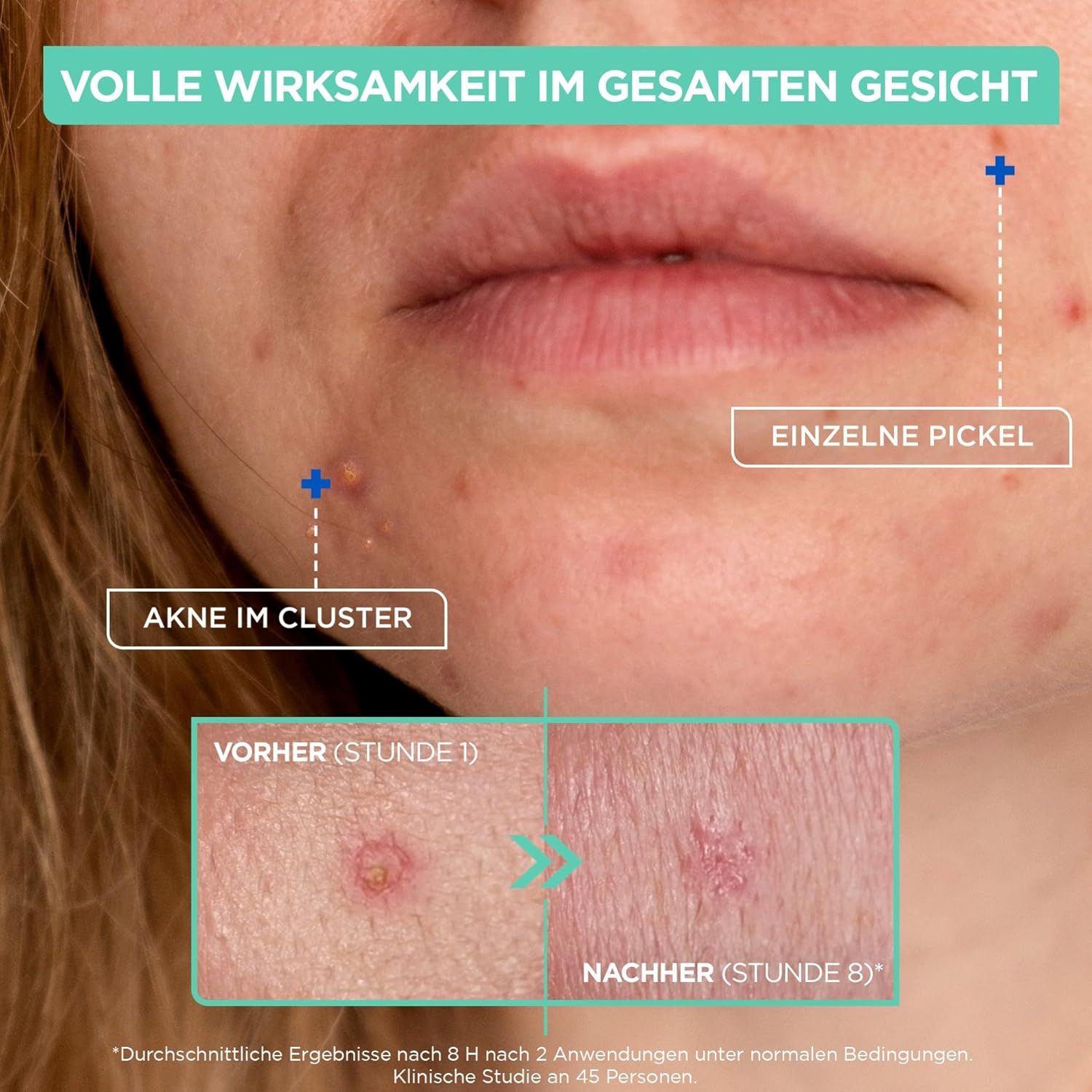 Nahaufnahme eines Gesichts mit Pickeln. Vergleichsbilder: Vorher (Stunde 1) und Nachher (Stunde 8) nach Anwendung.