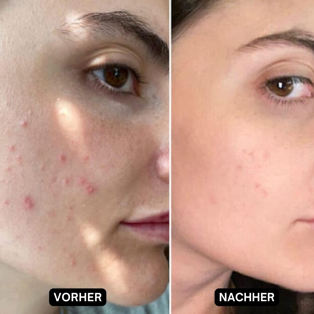 Vorher-Nachher-Vergleich. Gesicht mit Akne vor und nach der Behandlung.