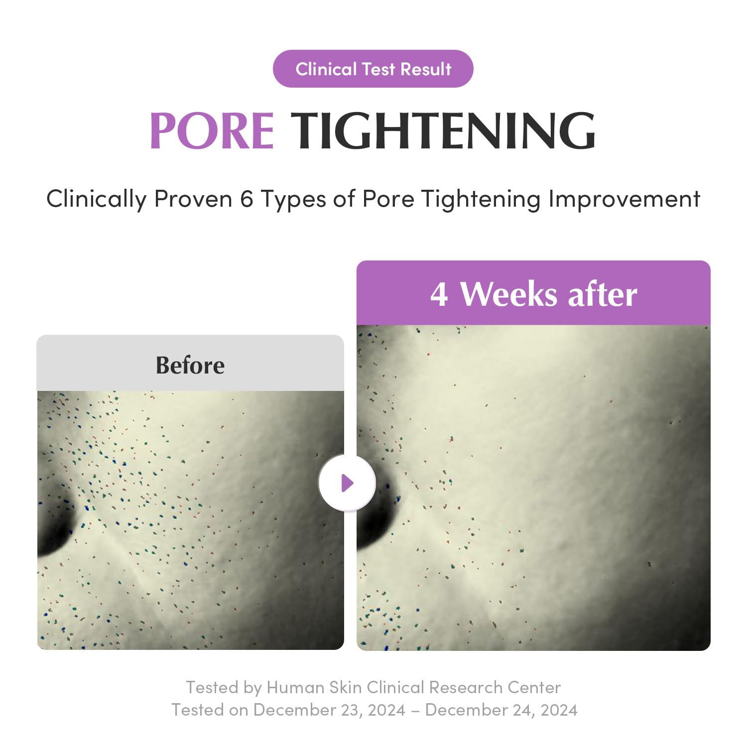 Vorher-Nachher-Vergleich. Haut mit Poren vor und nach 4 Wochen Behandlung. Text: Pore Tightening. Klinisch getestet.