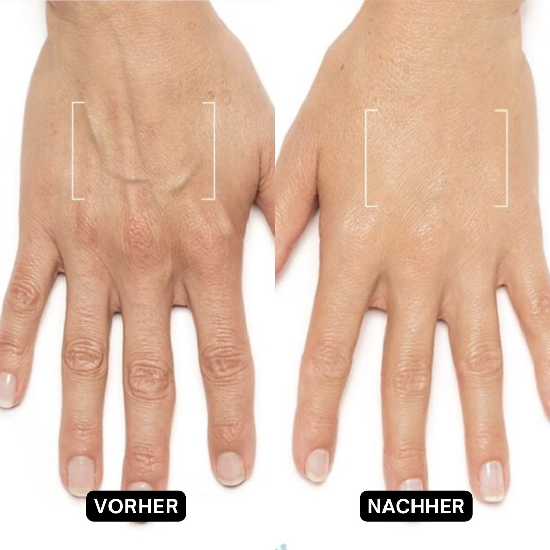 Zwei Hände, eine vor und eine nach der Anwendung. Text: Vorher, Nachher. Deutliche Verbesserung des Hautbildes.