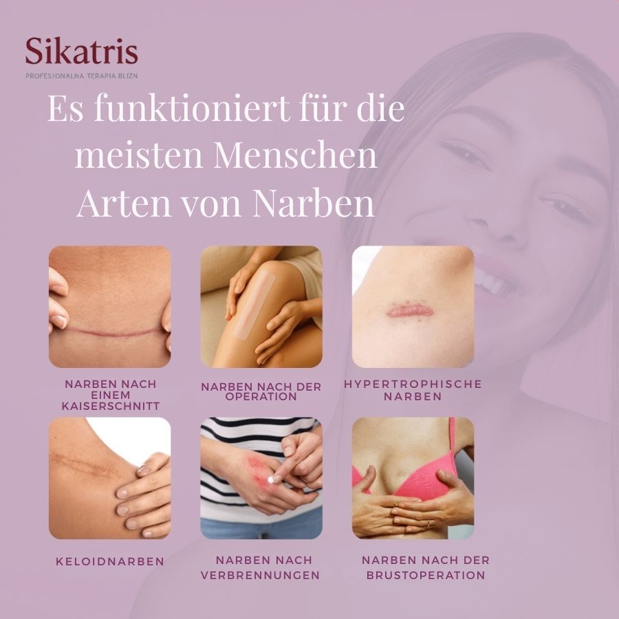 Illustrationen von Narbenarten. Text: Es funktioniert für die meisten Menschen.