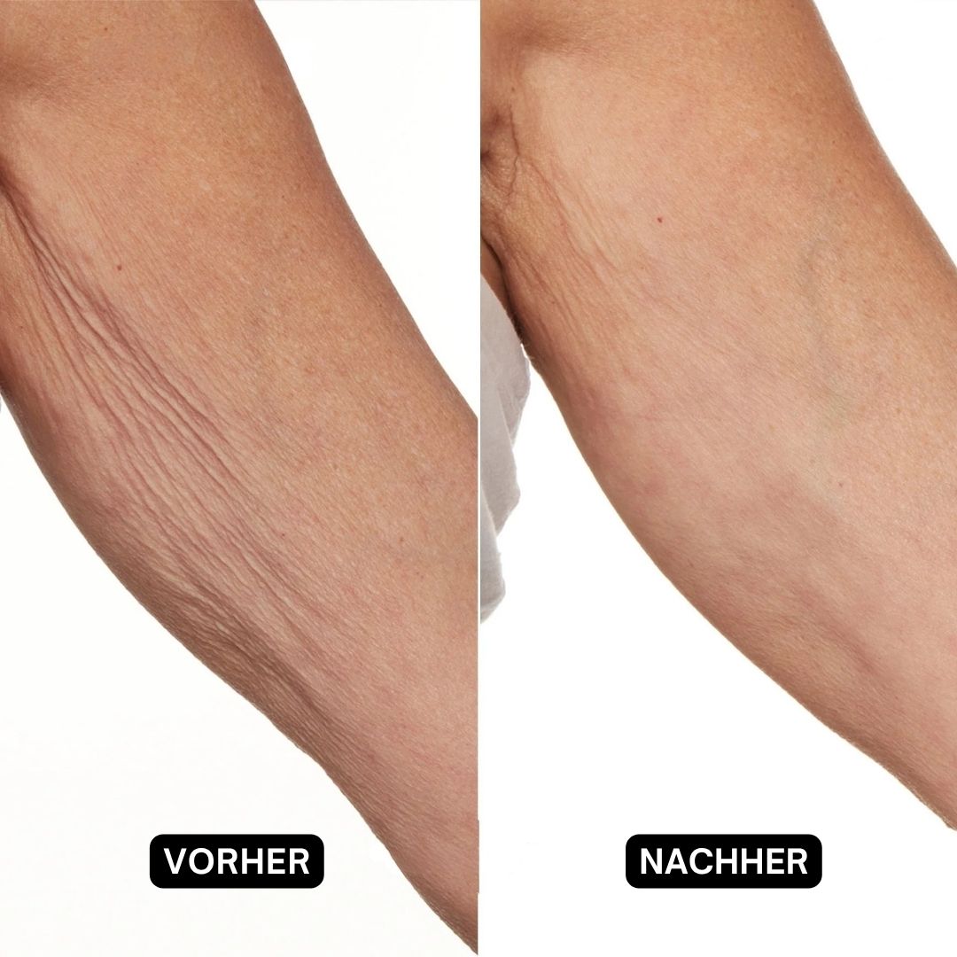 Vorher-Nachher-Vergleich von Haut an einem Arm. Links: faltige Haut. Rechts: glatte Haut.