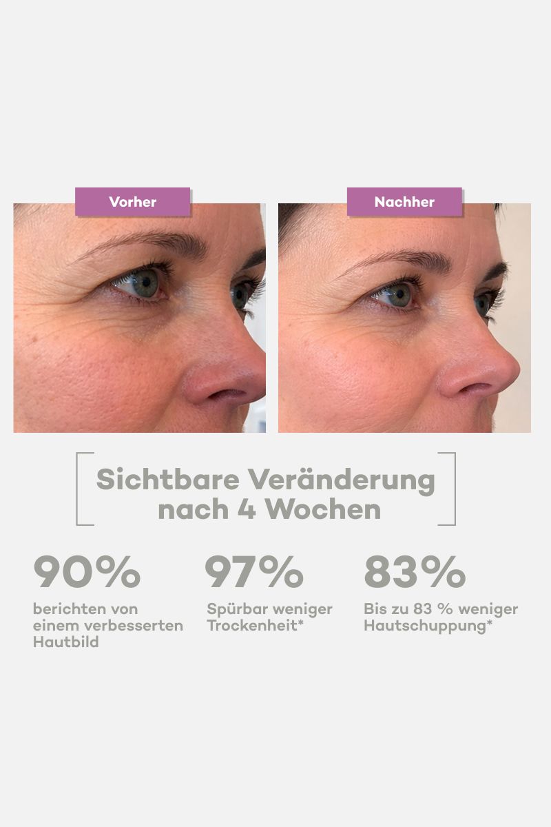 Vorher-Nachher-Vergleich von Haut. Text: Sichtbare Veränderungen nach 4 Wochen. 90% verbessertes Hautbild, 97% weniger Trockenheit, 83% weniger Hautschuppung.