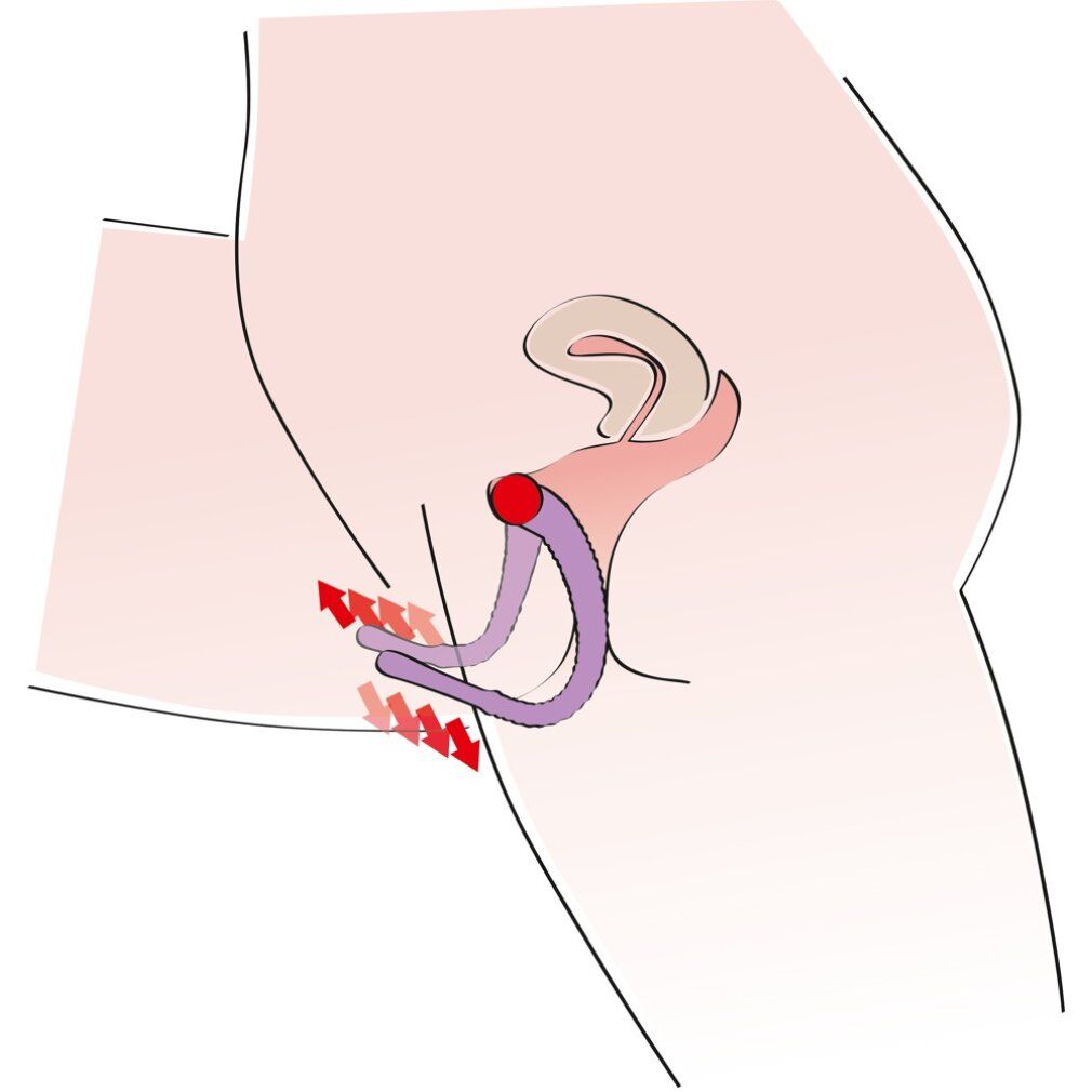 Schematische Darstellung des weiblichen Intimbereichs mit einem violetten, gebogenen Instrument und roten Pfeilen, die eine Bewegung anzeigen.