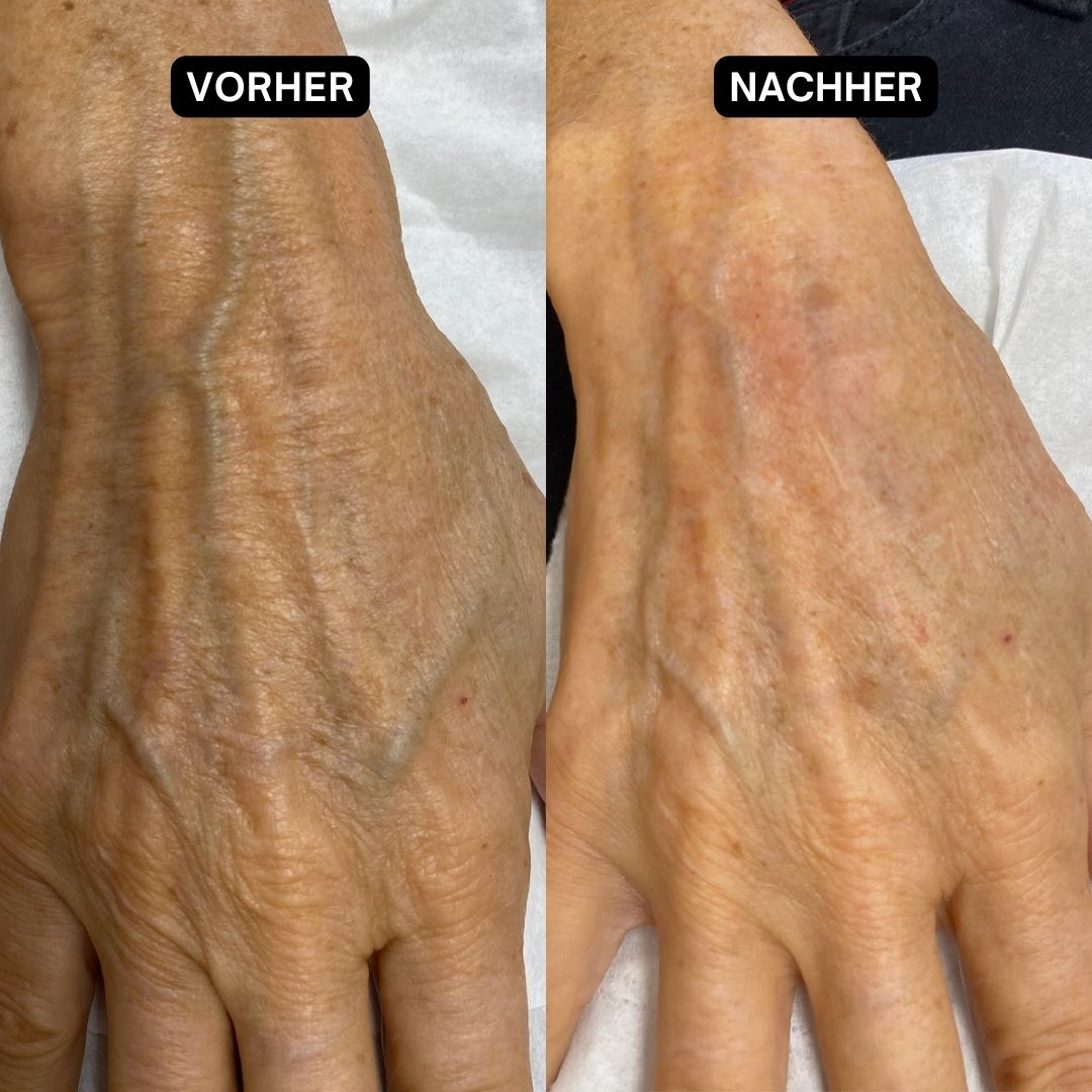 Zwei Hände, eine vor und eine nach der Anwendung. Die Haut wirkt nach der Anwendung glatter und weniger gerötet.