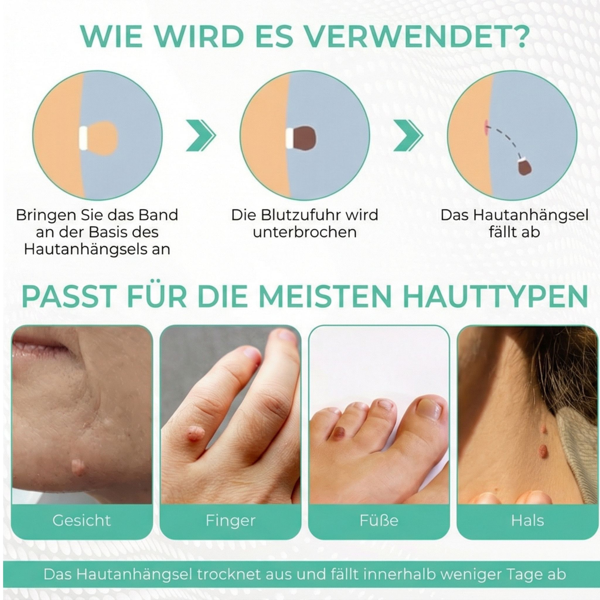 Anleitung zur Anwendung des Bandes zur Entfernung von Hautanhängseln. Geeignet für Gesicht, Finger, Füße, Hals.
