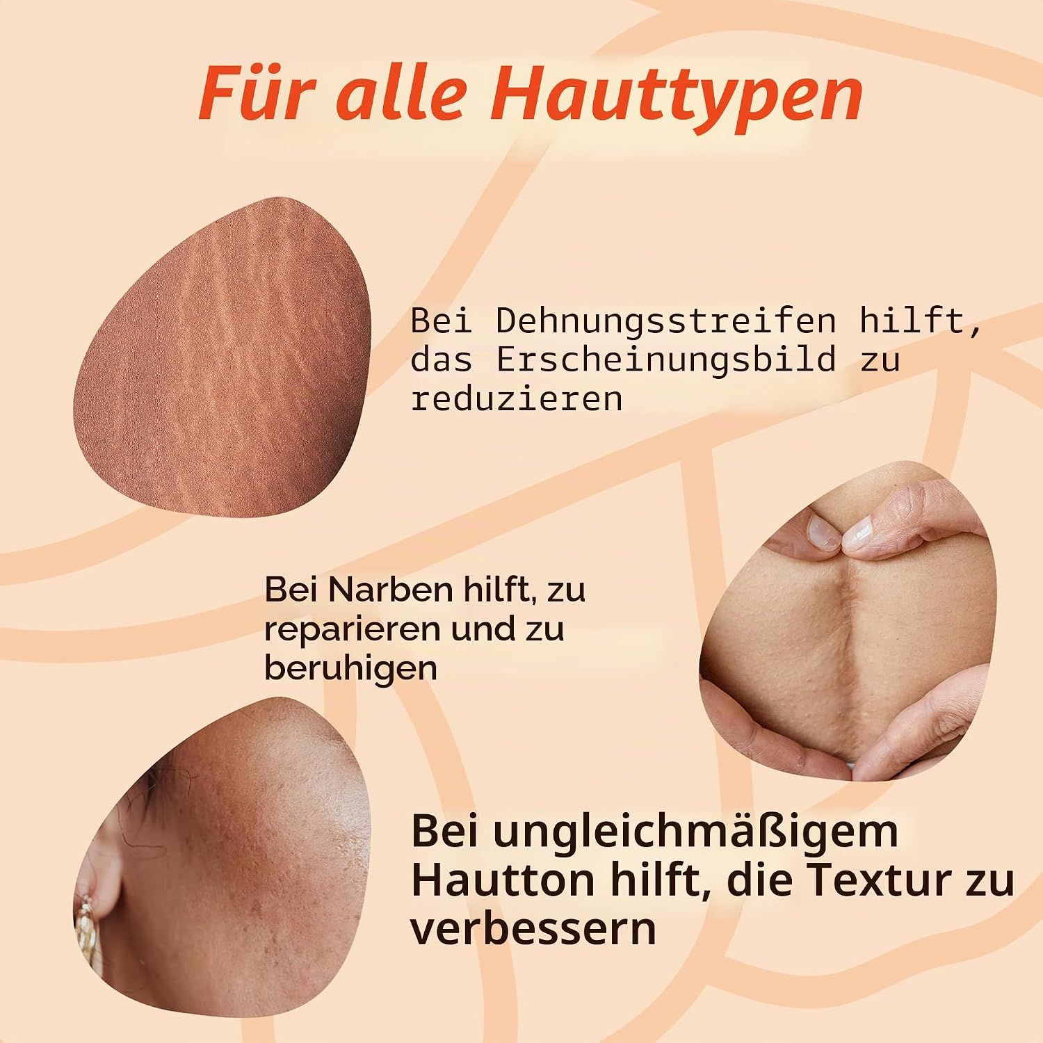 Bilder von Dehnungsstreifen, Narben und ungleichmäßiger Haut mit Text.