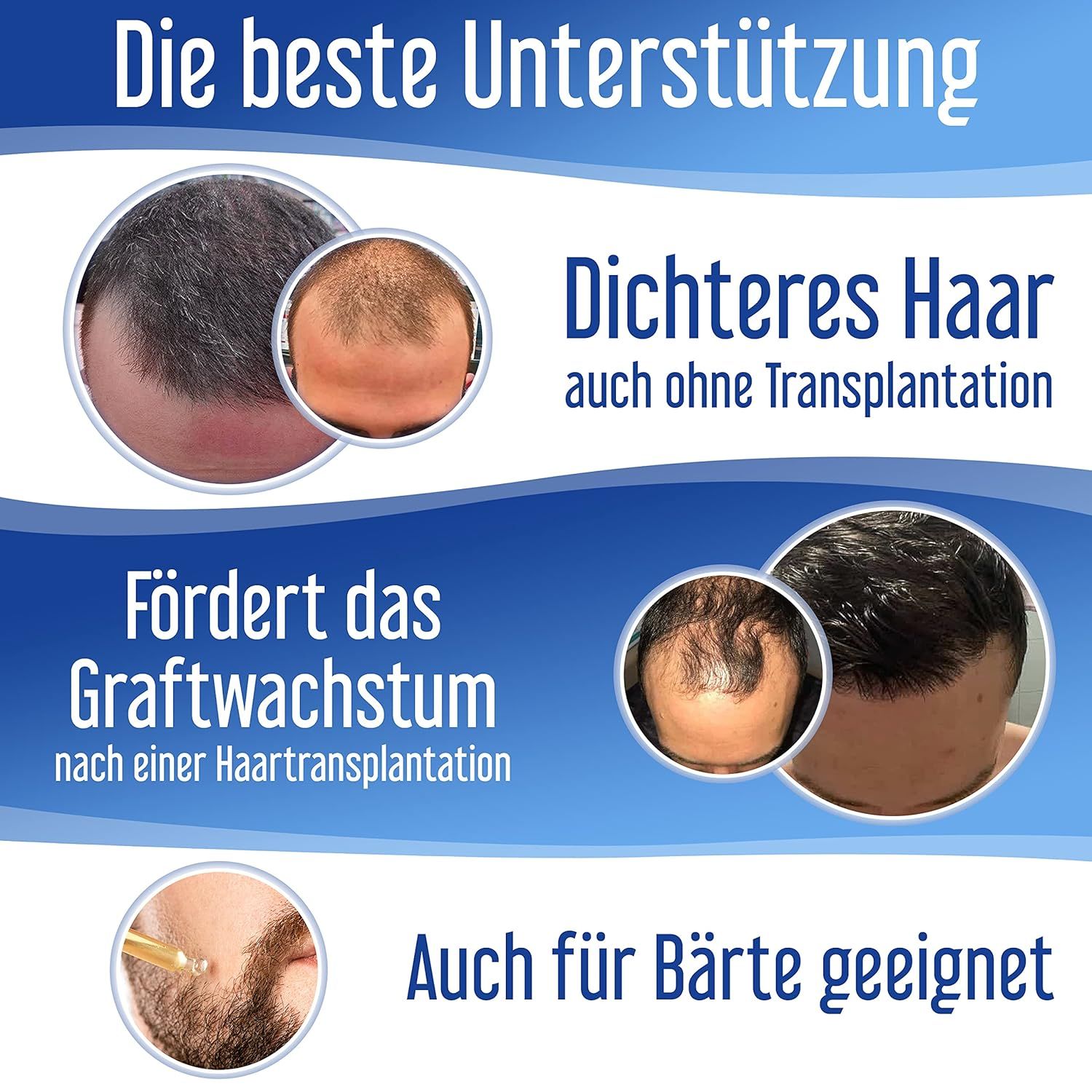 Hairforte Spray 3% Procapil gegen Haarverlust DHT Blocker
