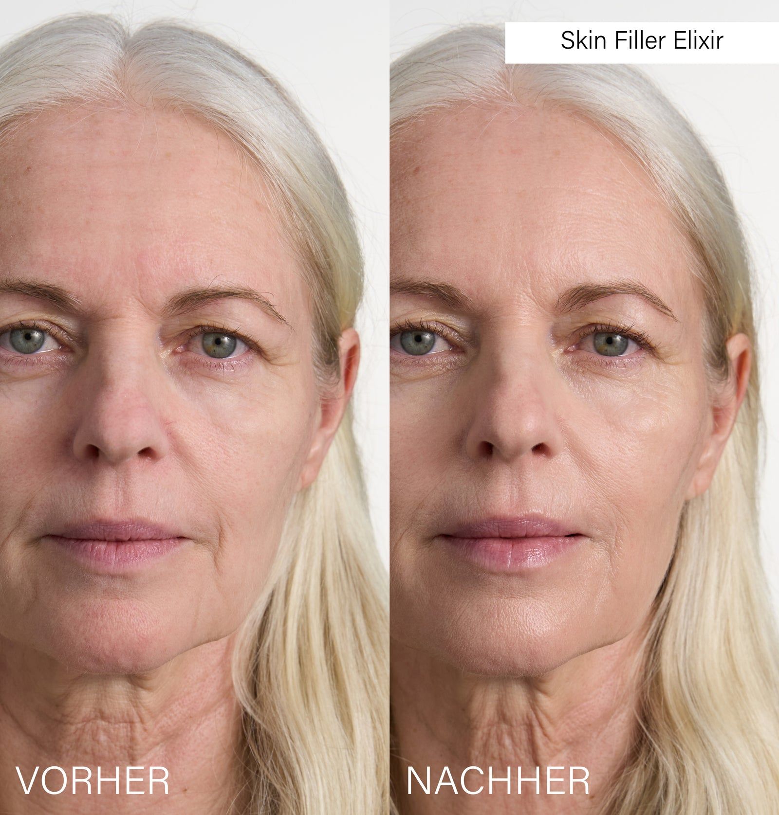 Vorher-Nachher-Vergleich. Auf der linken Seite steht „Vorher“, auf der rechten Seite „Nachher“. Die Haut wirkt glatter.