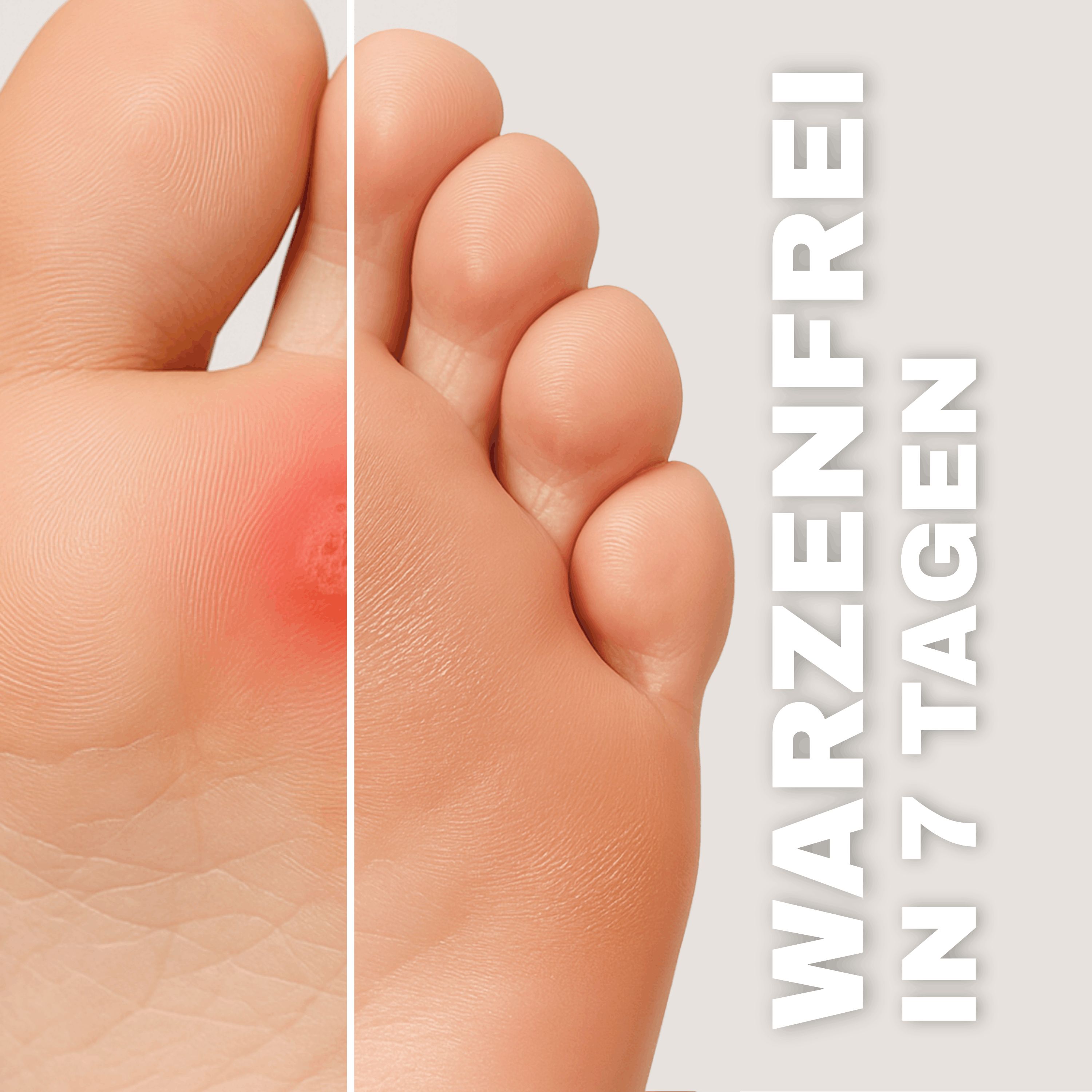 Health Press® Warzen Tinktur