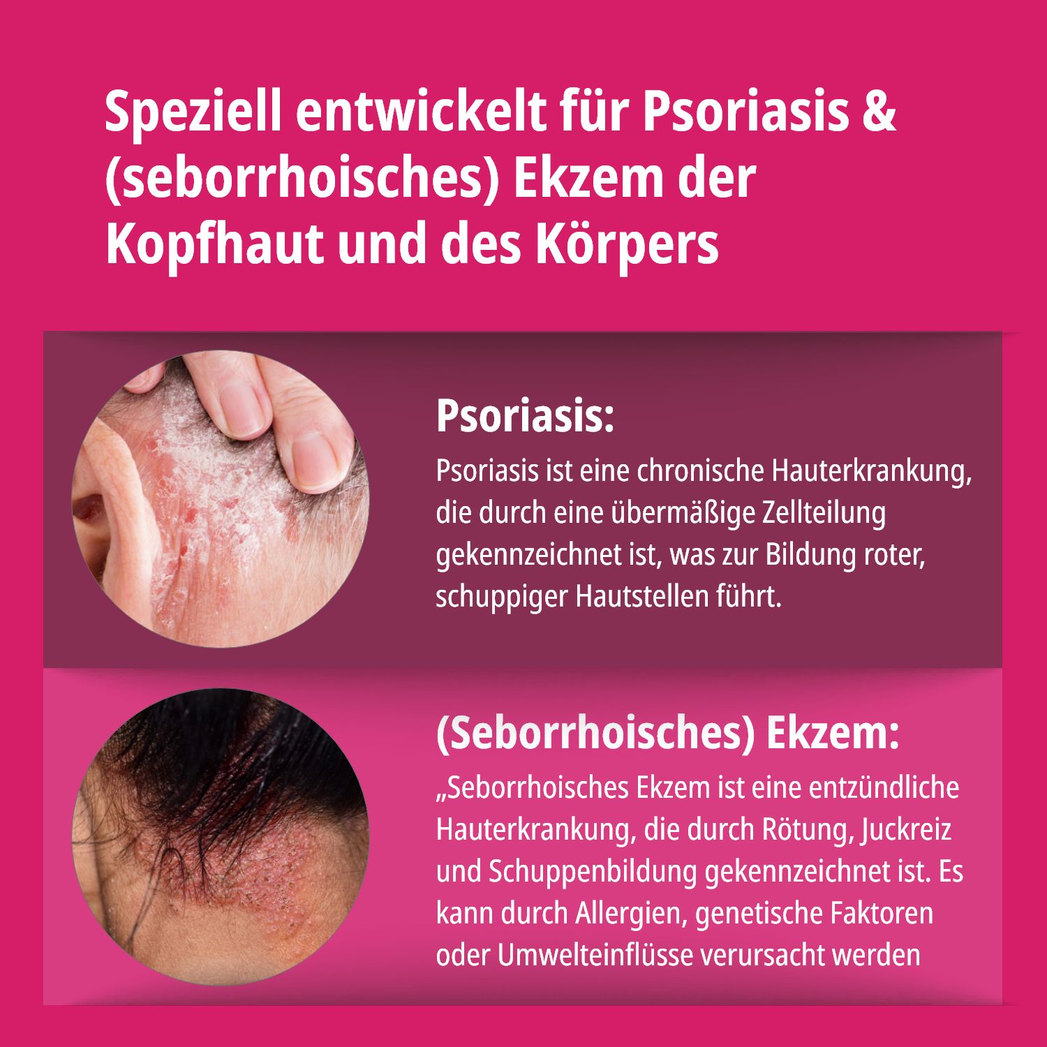 Evolsin® Psoriasis & Ekzem Lotion 3er Pack – Für Kopfhaut & Körper bei trockener Haut