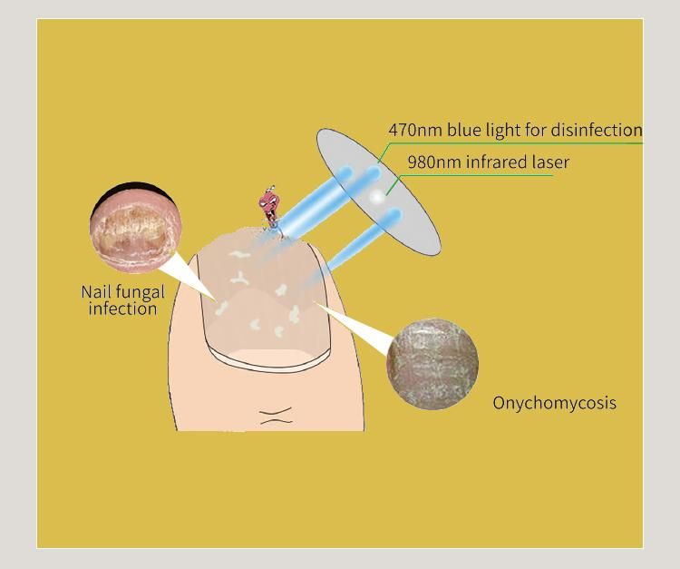 Diagramm mit einem Nagel, der von einem Gerät mit blauem Licht und Infrarotlaser behandelt wird. Beschriftungen: Nagelpilzinfektion, Onychomykose.
