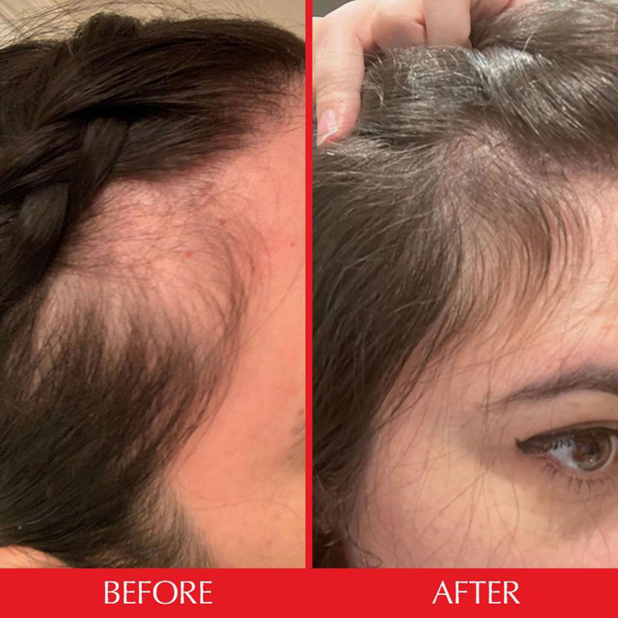 Vorher-Nachher-Vergleich: Haarausfall vor und nach der Anwendung. Beide Bilder zeigen den Haaransatz.