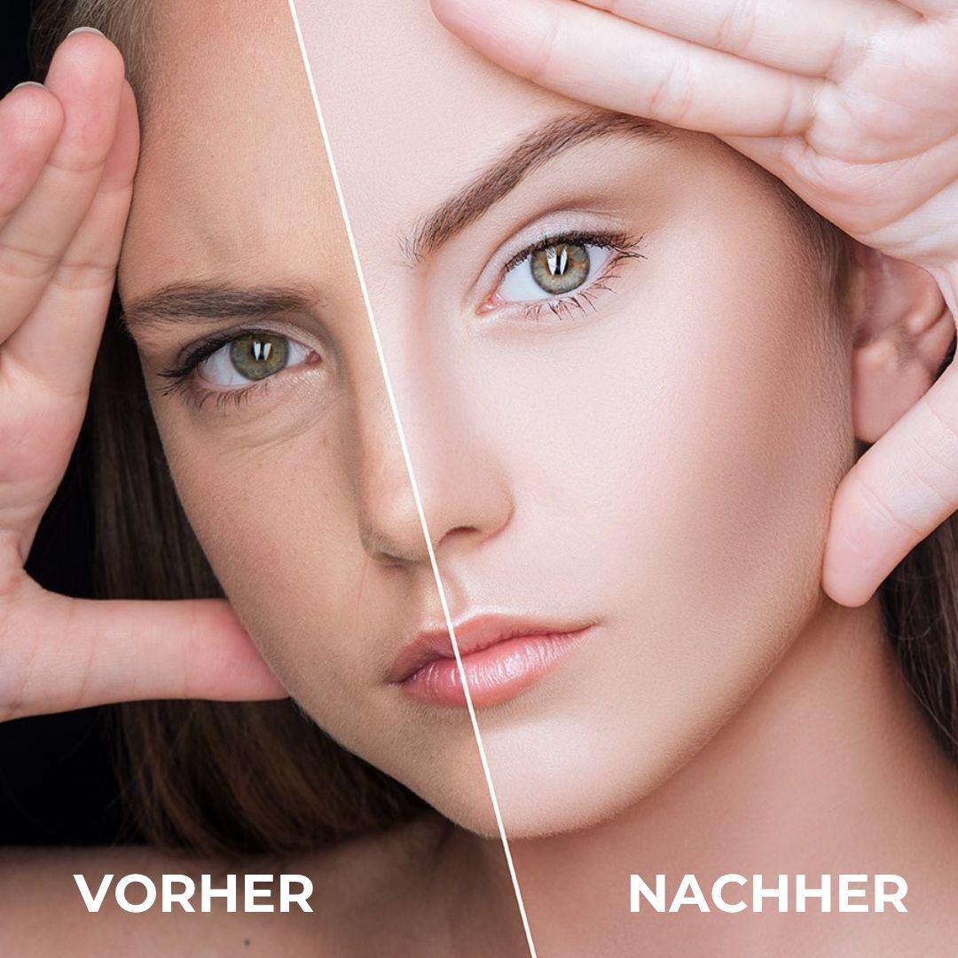 Vorher-Nachher-Vergleich. Gesicht einer Frau. Eine Gesichtshälfte: Hautunreinheiten. Andere Hälfte: glatte Haut.