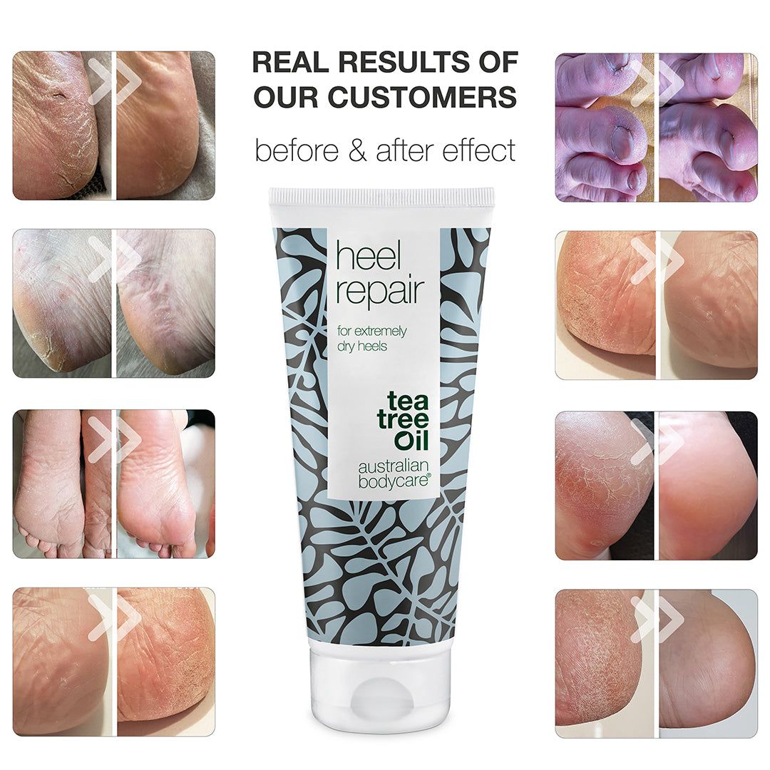 Vorher-Nachher-Vergleich von Füßen. Tube Heel Repair, Tea Tree Oil, Australian Bodycare.