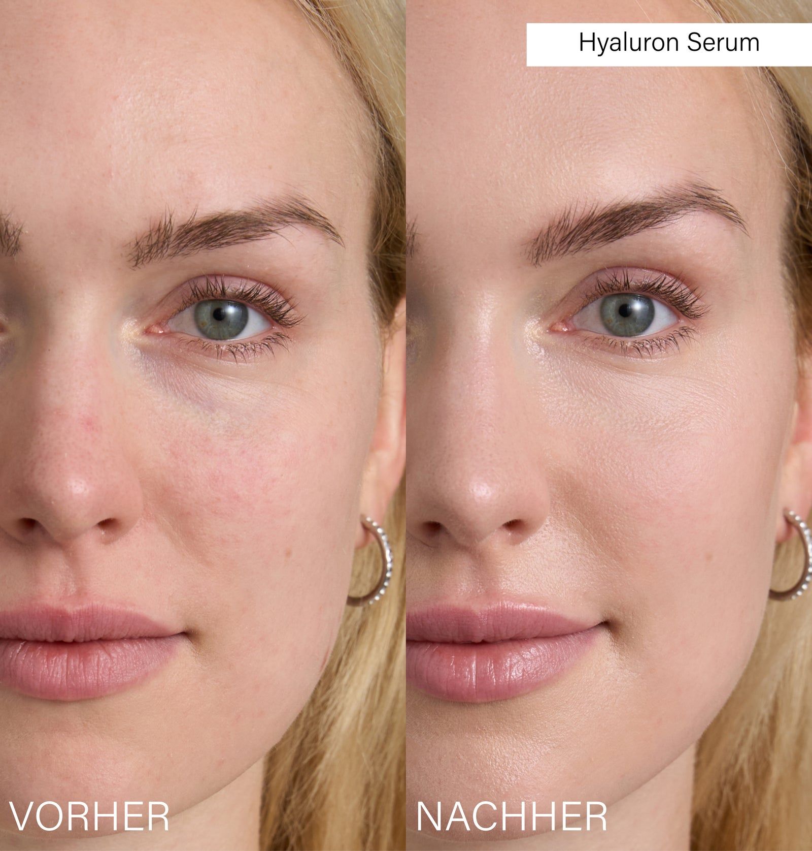 Gesicht, links mit Hautunreinheiten, rechts glatt. Beschriftung: Hyaluron Serum. Vorher/Nachher-Vergleich.