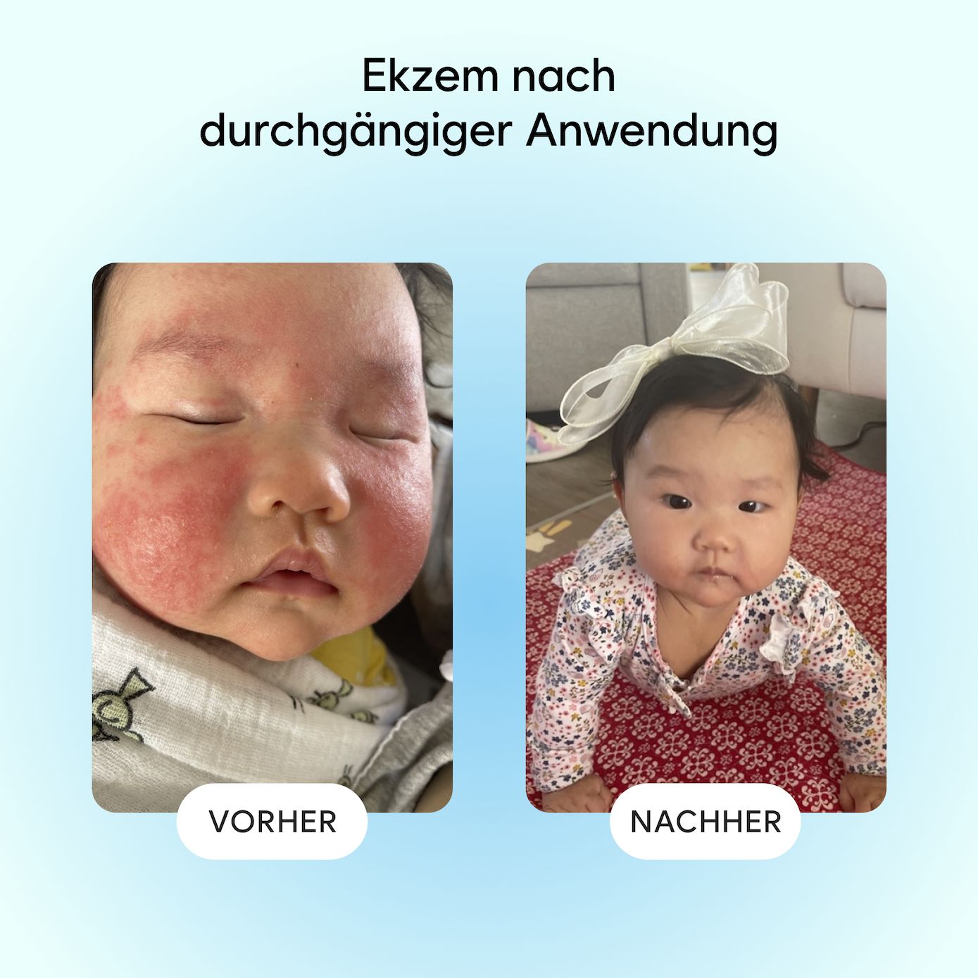 Vorher-Nachher-Bilder eines Babys mit Ekzem. Links: Rötungen im Gesicht. Rechts: Haut ohne Rötungen. Aufschrift: Ekzem nach Anwendung.