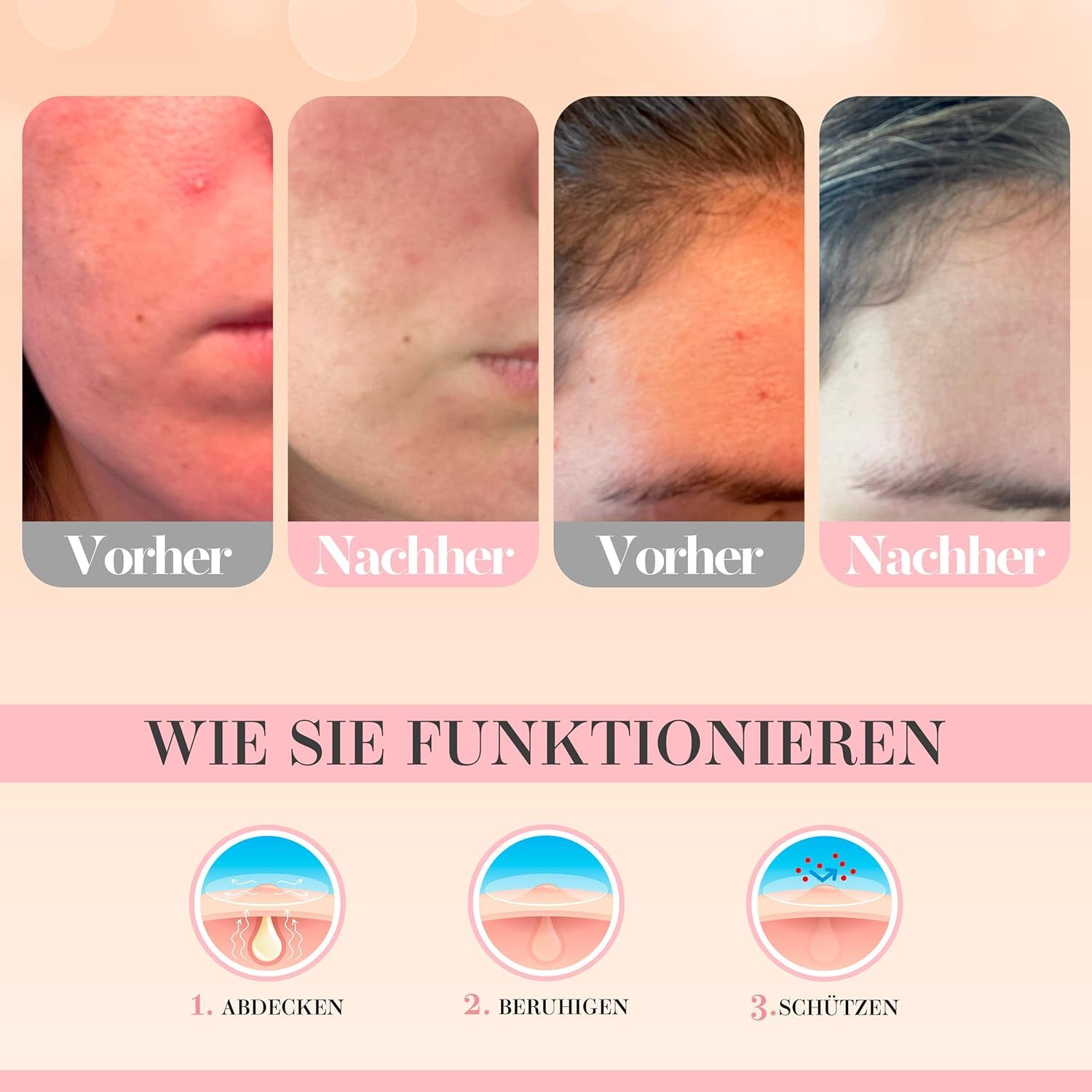 Vorher-Nachher-Vergleich von Hautunreinheiten. Zeigt Ergebnisse nach der Anwendung von Glacia Pickel Patches.