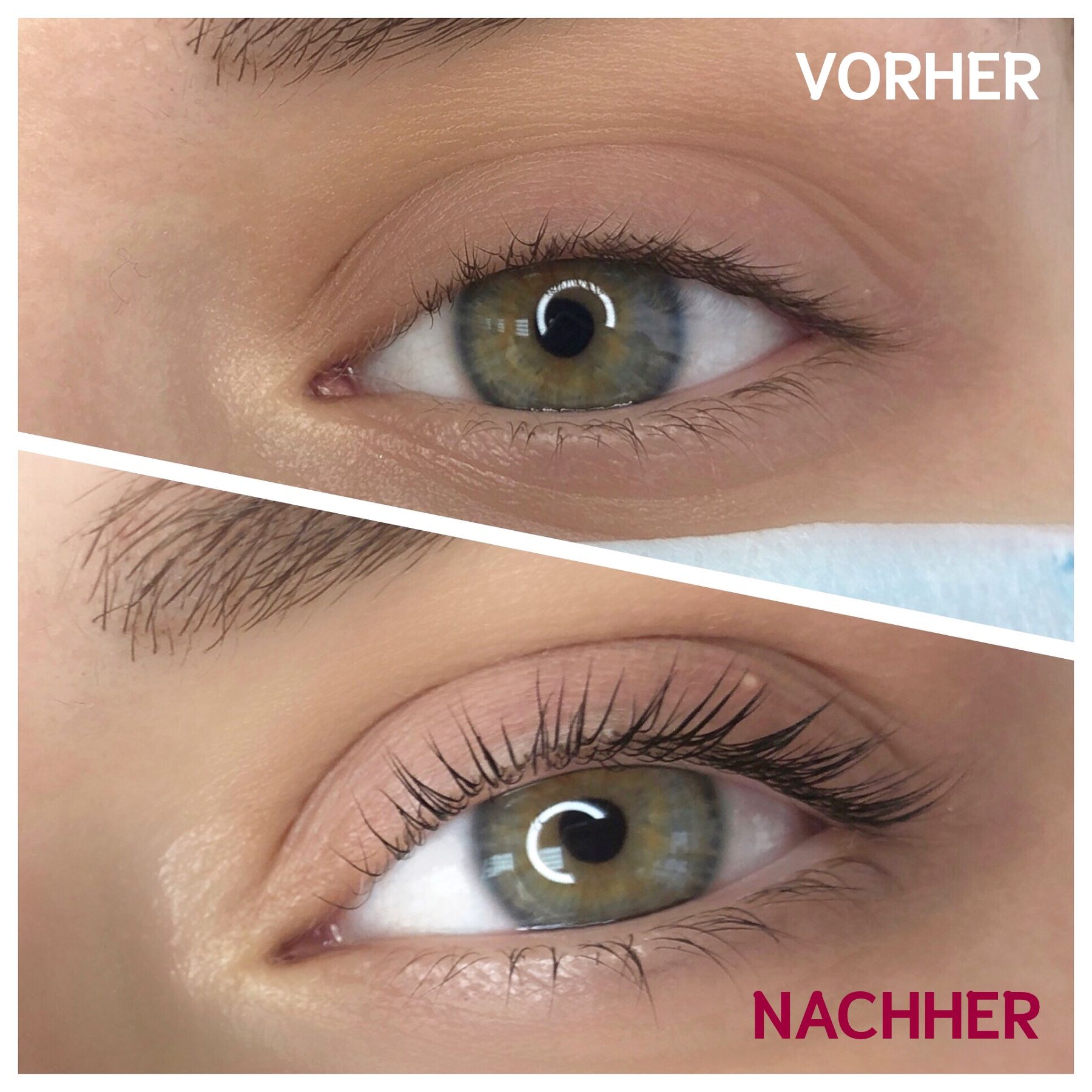 Vorher-Nachher-Vergleich von Augen. Obere Augenpartie vor der Behandlung, untere danach.