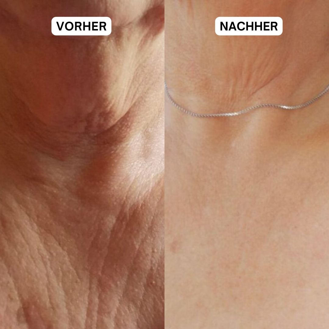 Vorher-Nachher-Vergleich von Hals. Links: faltige Haut. Rechts: glattere Haut.