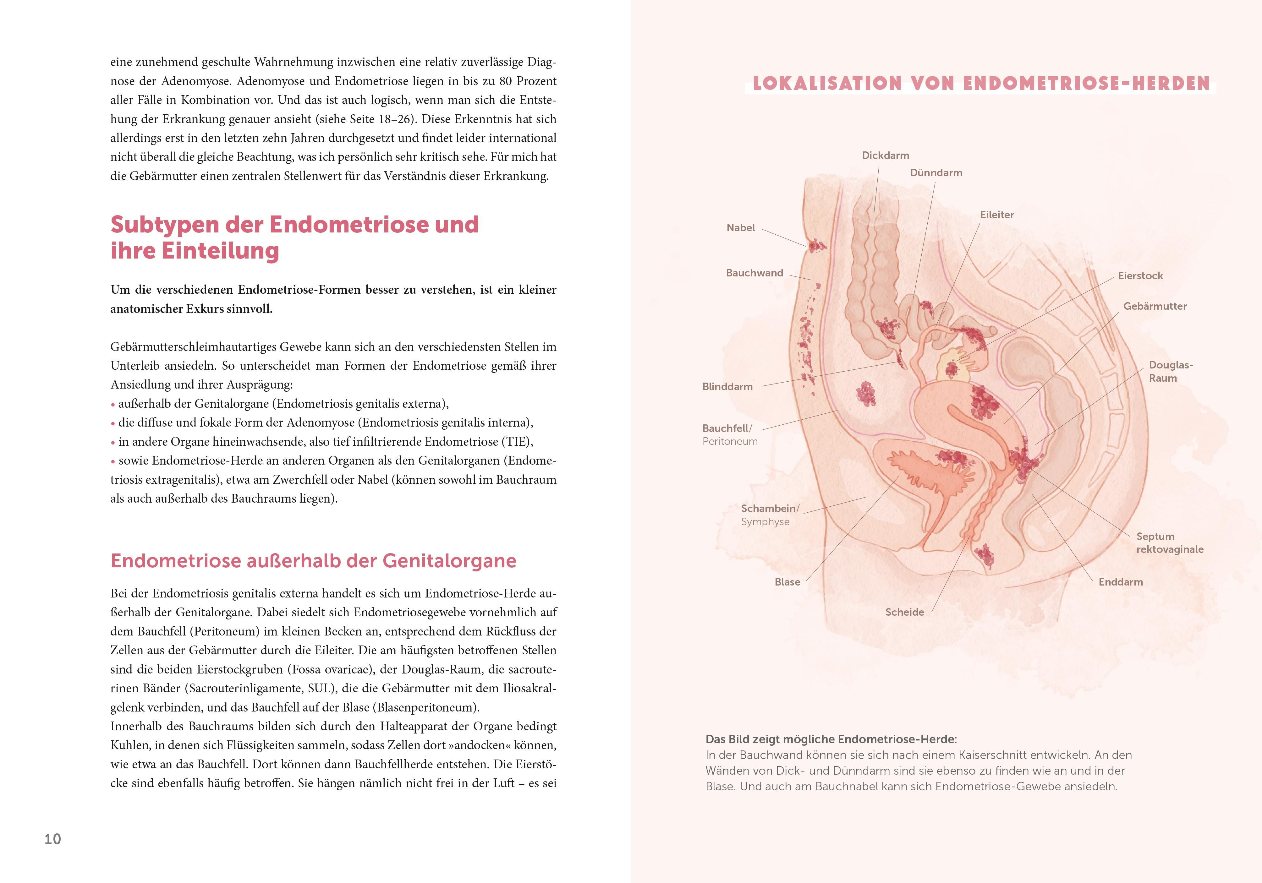 Endometriose - Die unterschätzte Krankheit