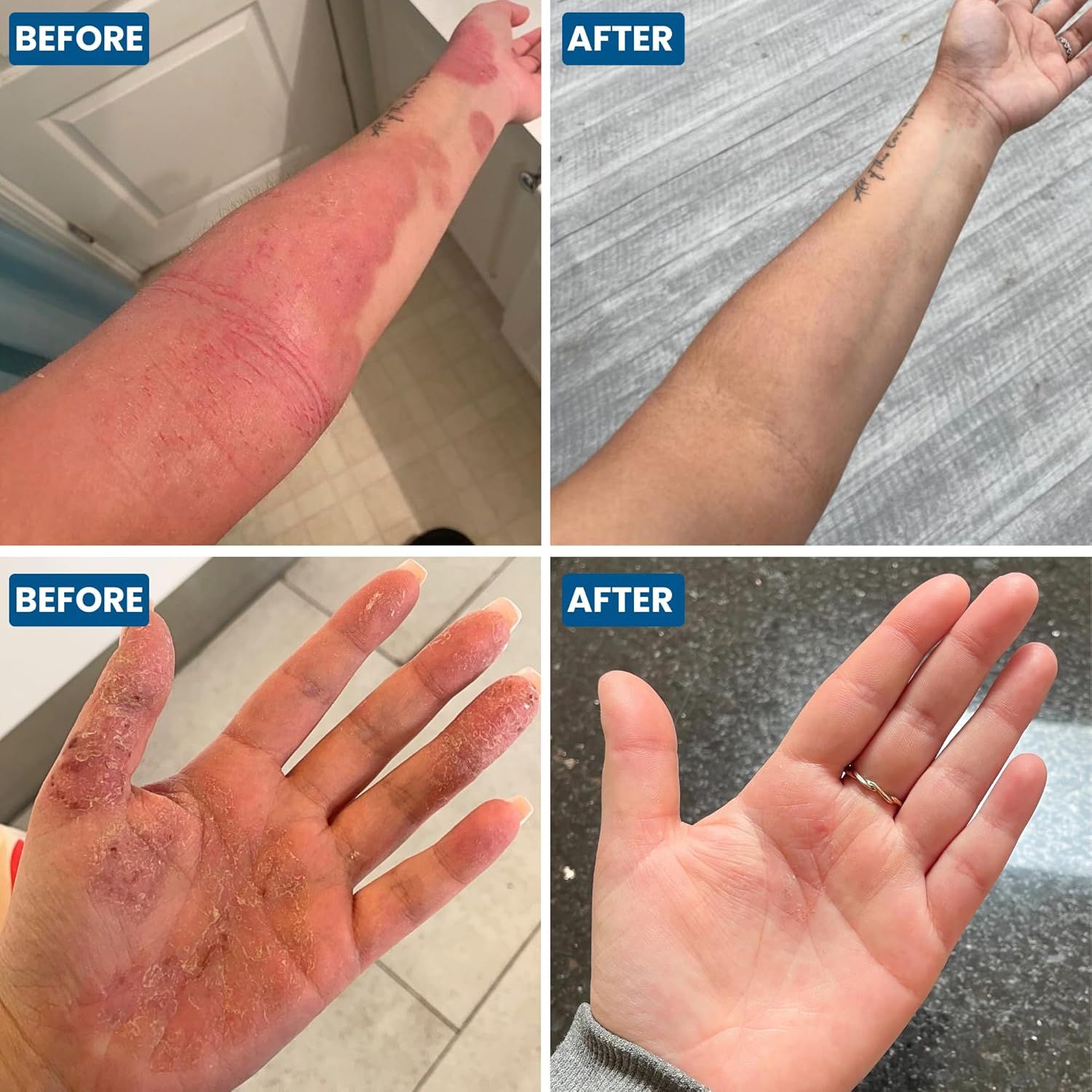 Arme und Hände vor und nach der Anwendung. Hautrötungen und Ekzeme sind vor der Anwendung sichtbar.