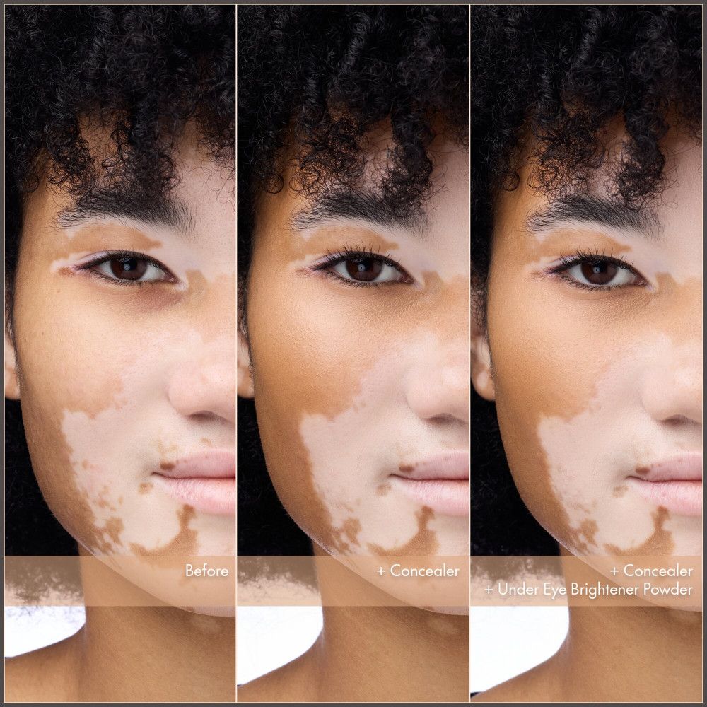 Gesicht einer Person mit Vitiligo, geteilt in drei Abschnitte: Vorher, mit Concealer, mit Concealer und Aufhellungspuder.