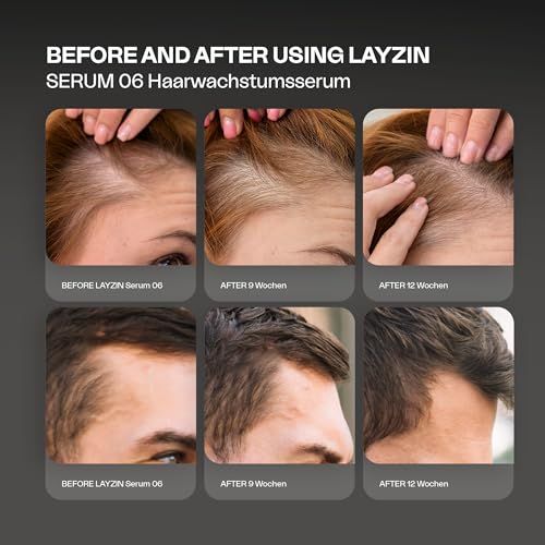 Vorher-Nachher-Bilder. Haare vor und nach 9 und 12 Wochen. Text: BEFORE AND AFTER USING LAYZIN.