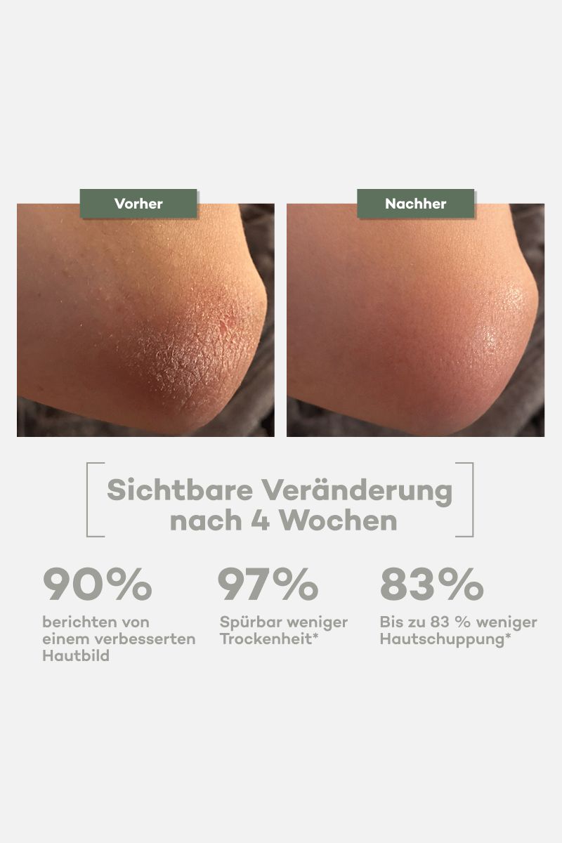 Vorher-Nachher-Vergleich von Ellenbogenhaut. Text: Sichtbare Veränderung nach 4 Wochen. Prozentangaben zu Verbesserung.