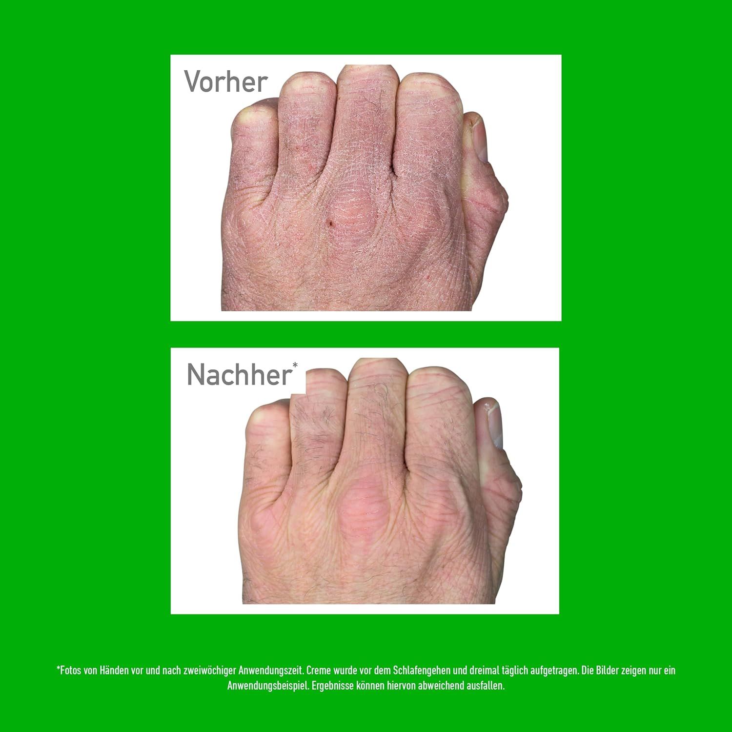 Vorher-Nachher-Vergleich von Händen. Oben: rissige Haut. Unten: verbesserte Haut. Text: Fotos vor und nach Anwendung.