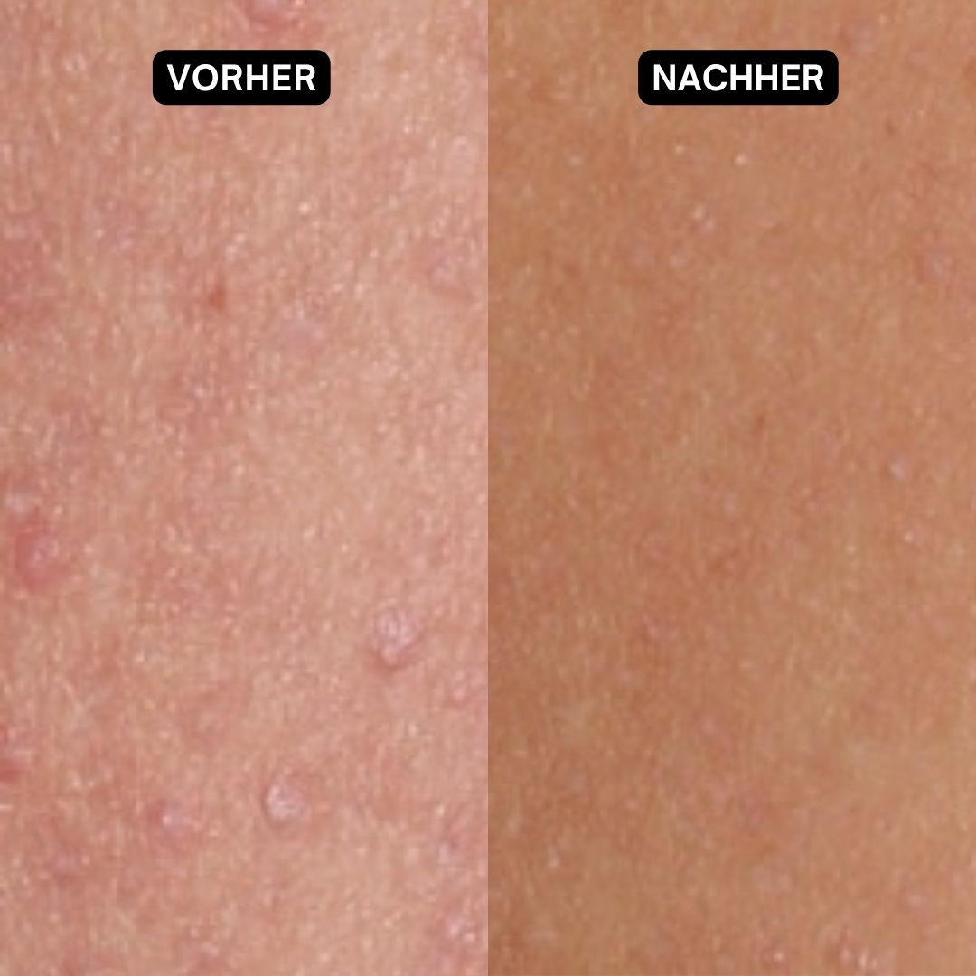 Hautvergleich: Vorher und Nachher. Haut mit Rötungen und Pickeln. Nachher: glatte Haut. Text: „Vorher“ und „Nachher“.