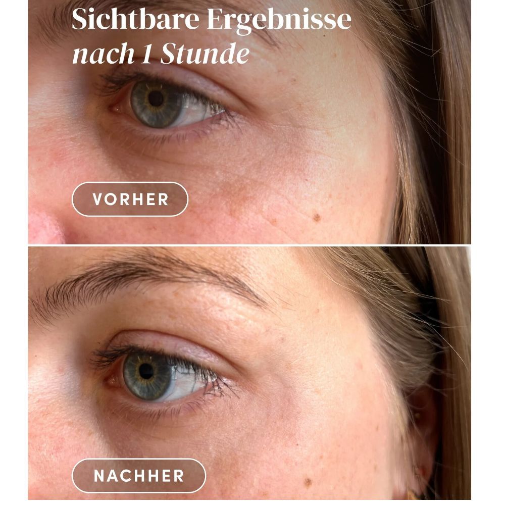 Vorher-Nachher-Vergleich der Augenpartie. Zeigt Ergebnisse nach 1 Stunde. Deutliche Verbesserung sichtbar.