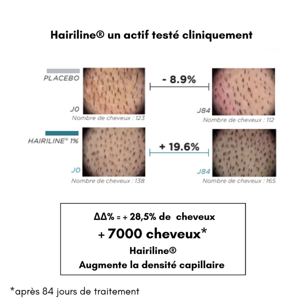 Haarwachstum-Vergleich. Placebo vs. Hairiline 1%. Diagramm zeigt Haardichte-Veränderung. Text: +28,5% Haare, +7000 Haare, erhöht die Haardichte.