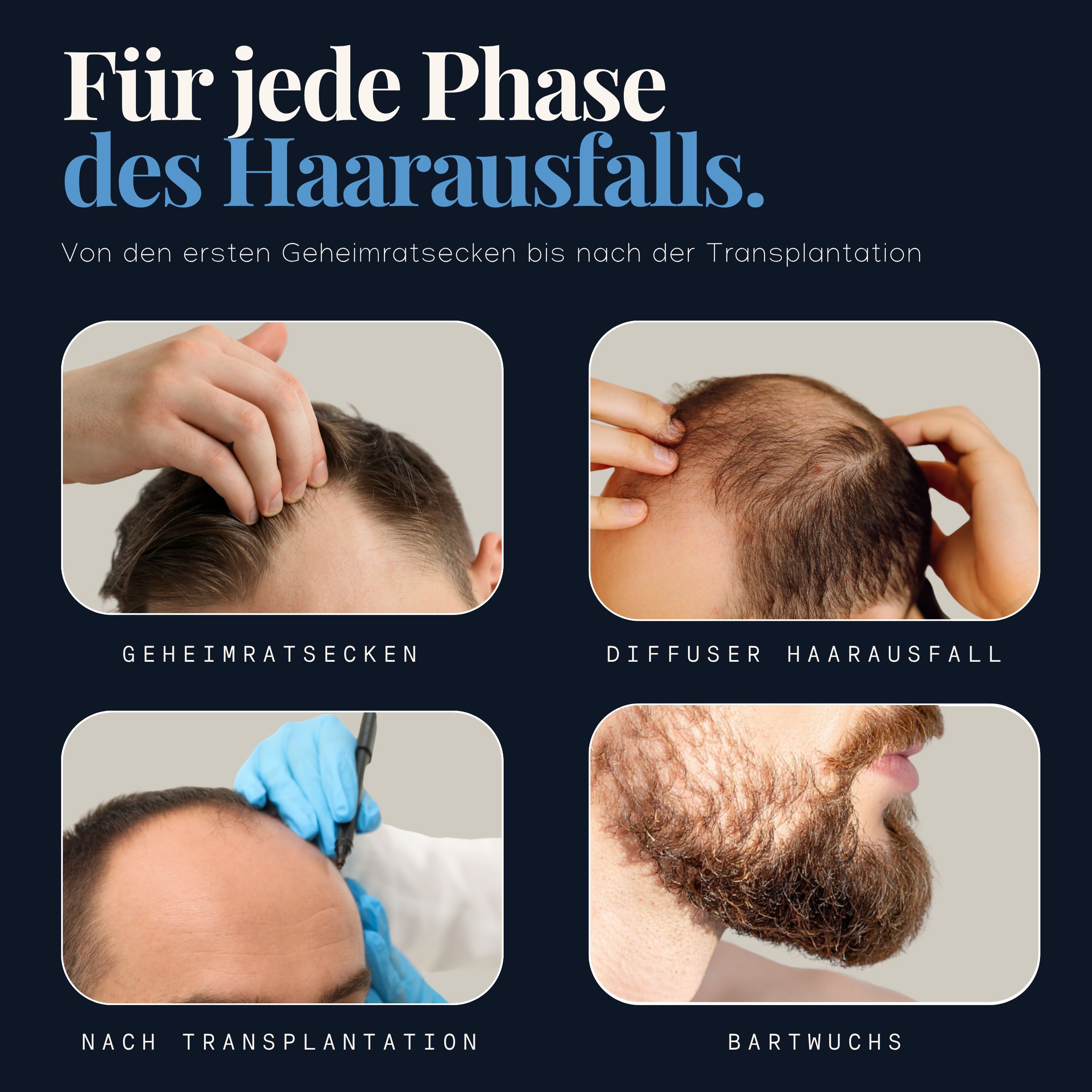 Phasen des Haarausfalls: Geheimratsecken, diffuser Haarausfall, nach Transplantation, Bartwuchs.