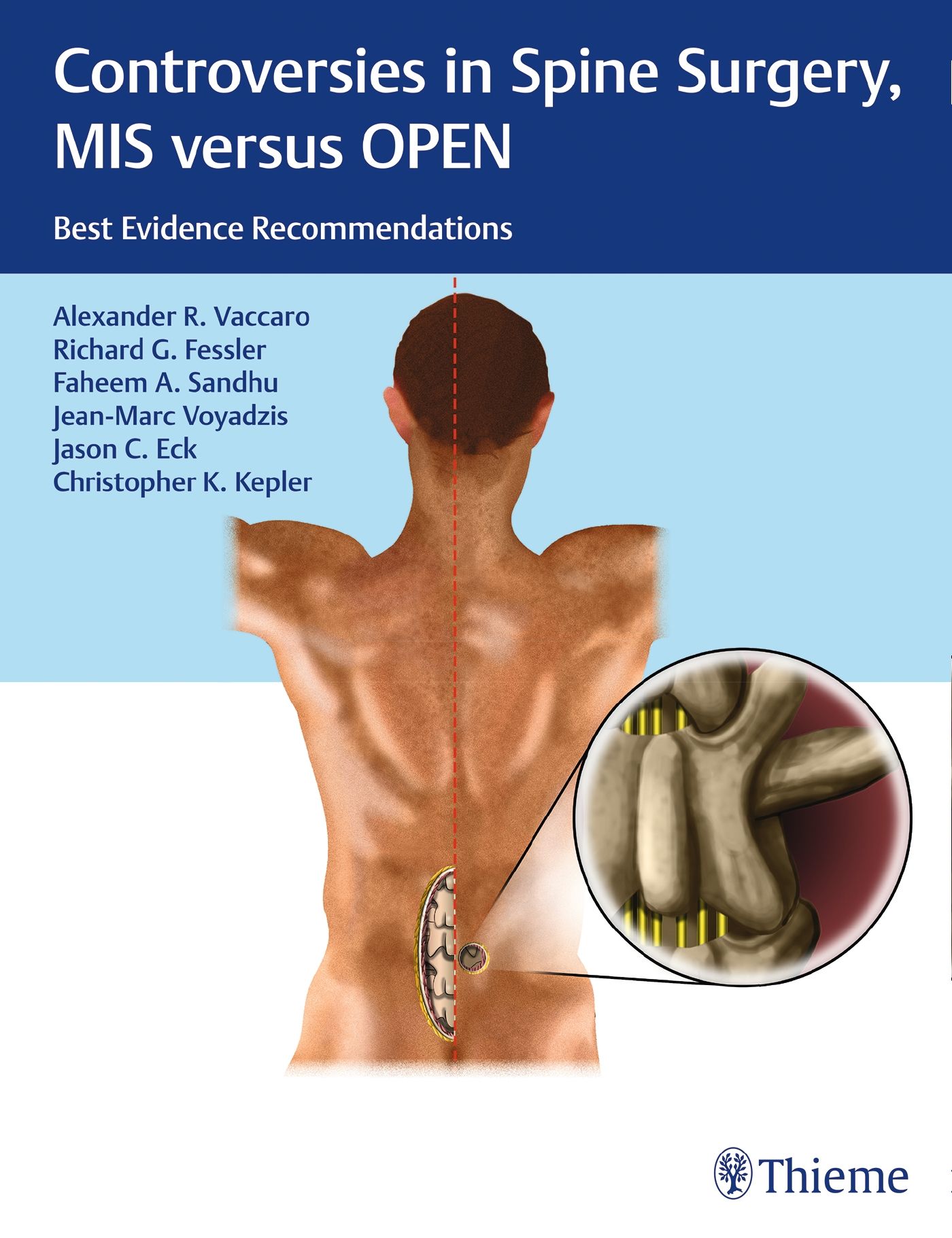 Buchcover: "Controversies in Spine Surgery, MIS versus OPEN". Autorenliste. Illustration der Wirbelsäule mit Detailansicht.