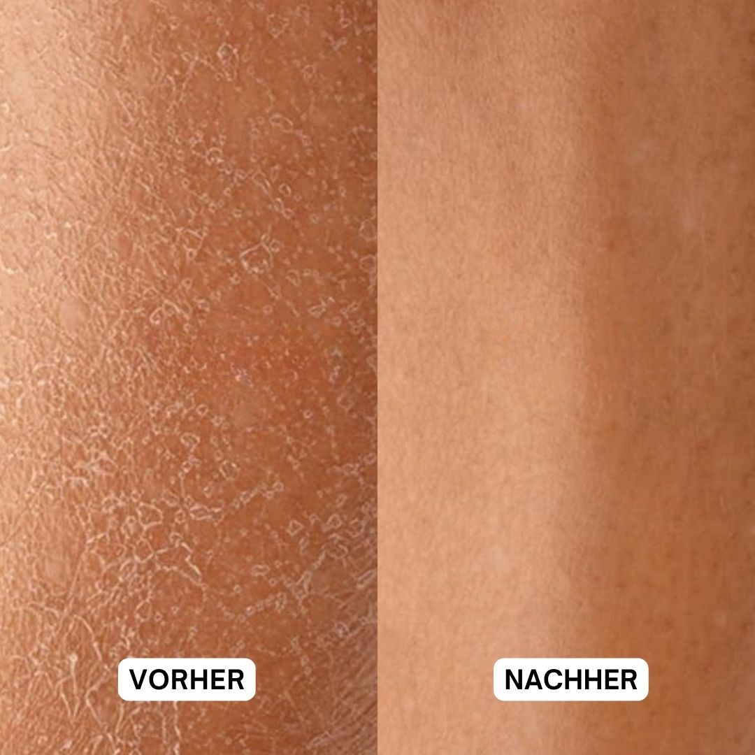 Vorher-Nachher-Vergleich. Haut mit trockenen Stellen, dann glatte Haut.