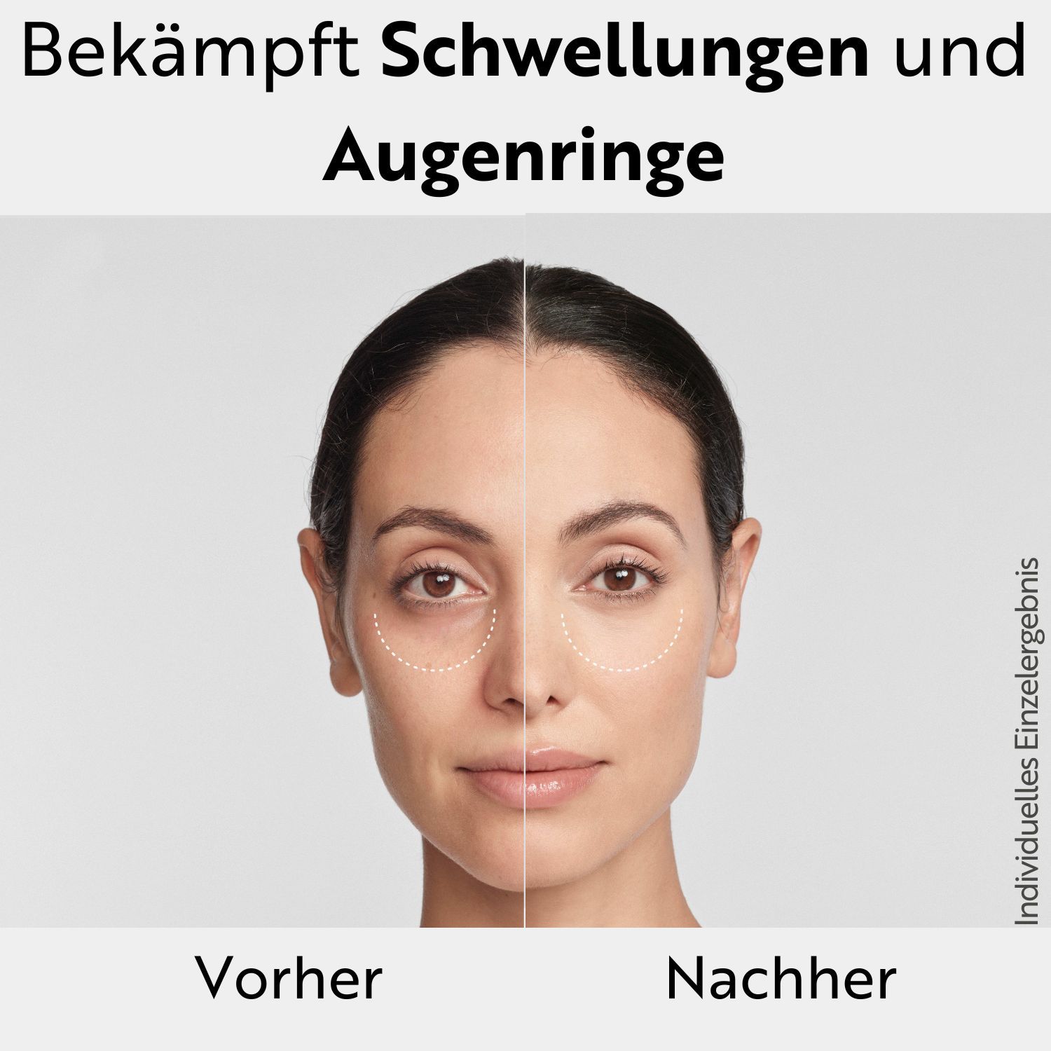Vorher-Nachher-Bild einer Frau. Text: Bekämpft Schwellungen und Augenringe. Schematische Darstellung.