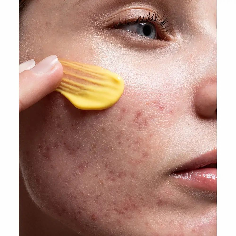 Gelbe Creme auf Gesicht aufgetragen. Haut mit Rötungen und Pickeln. Finger berühren die Creme.