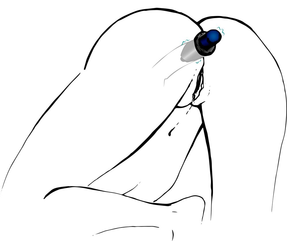 Skizze eines Lust Tunnel Plugs, der in einer Person verwendet wird. Blaues Detail.